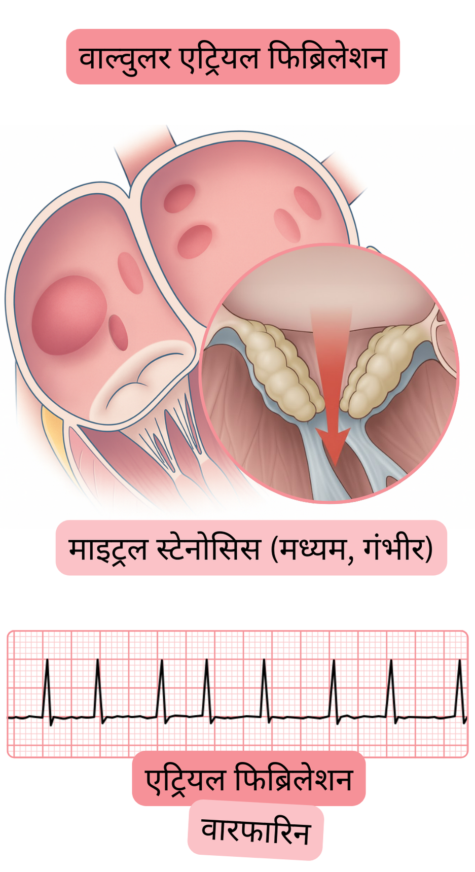 यह चित्र मध्यम से गंभीर माइट्रल स्टेनोसिस में वाल्वुलर एट्रियल फिब्रिलेशन को दर्शाता है, जिसमें एट्रियल फिब्रिलेशन का ईसीजी रिकॉर्ड और वारफारिन से एंटीकॉगुलेंट उपचार की संकेतना शामिल है।