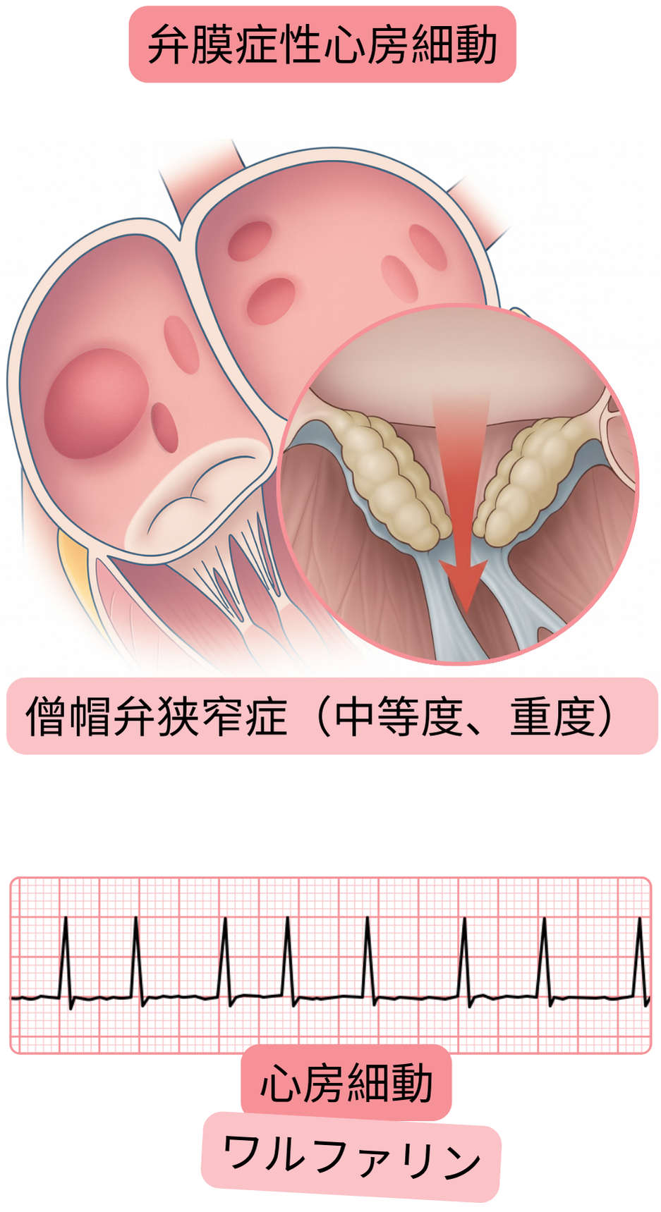 中等度から重度の僧帽弁狭窄症における弁膜症性心房細動を示し、心房細動の心電図所見とワルファリンによる抗凝固療法の適応を示したイラスト。