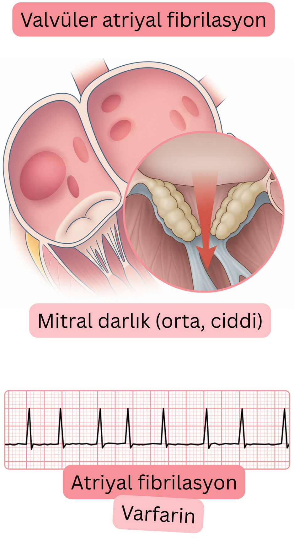 Orta-ileri derecede mitral darlıkta valvüler atriyal fibrilasyonu, atriyal fibrilasyon EKG kaydı ve warfarin ile antikoagülan tedavi endikasyonunu gösteren ilustrasyon.