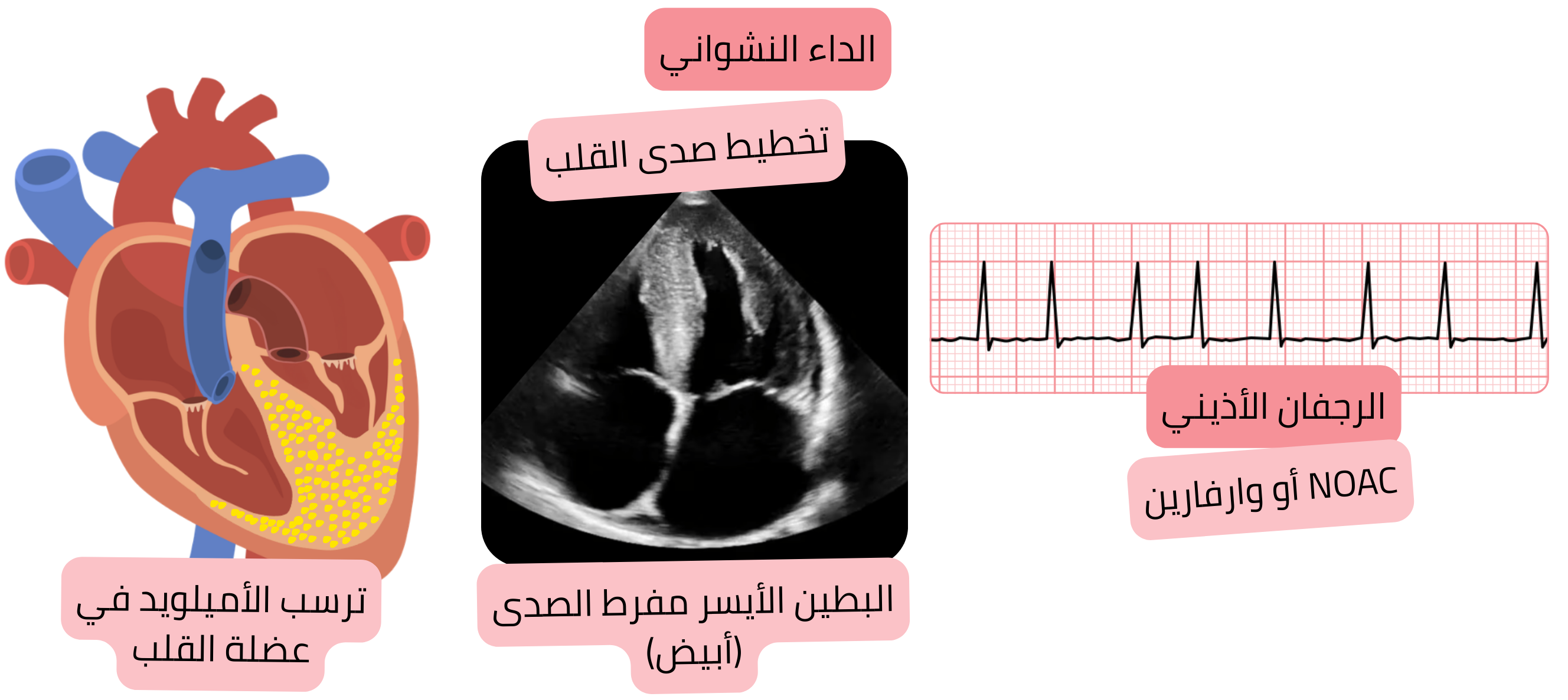 رسم توضيحي للرجفان الأذيني في الداء النشواني القلبي مع بطين أيسر مفرط الصدى في تخطيط صدى القلب ودواعي العلاج المضاد للتخثر باستخدام مضادات التخثر الفموية الحديثة أو الوارفارين.