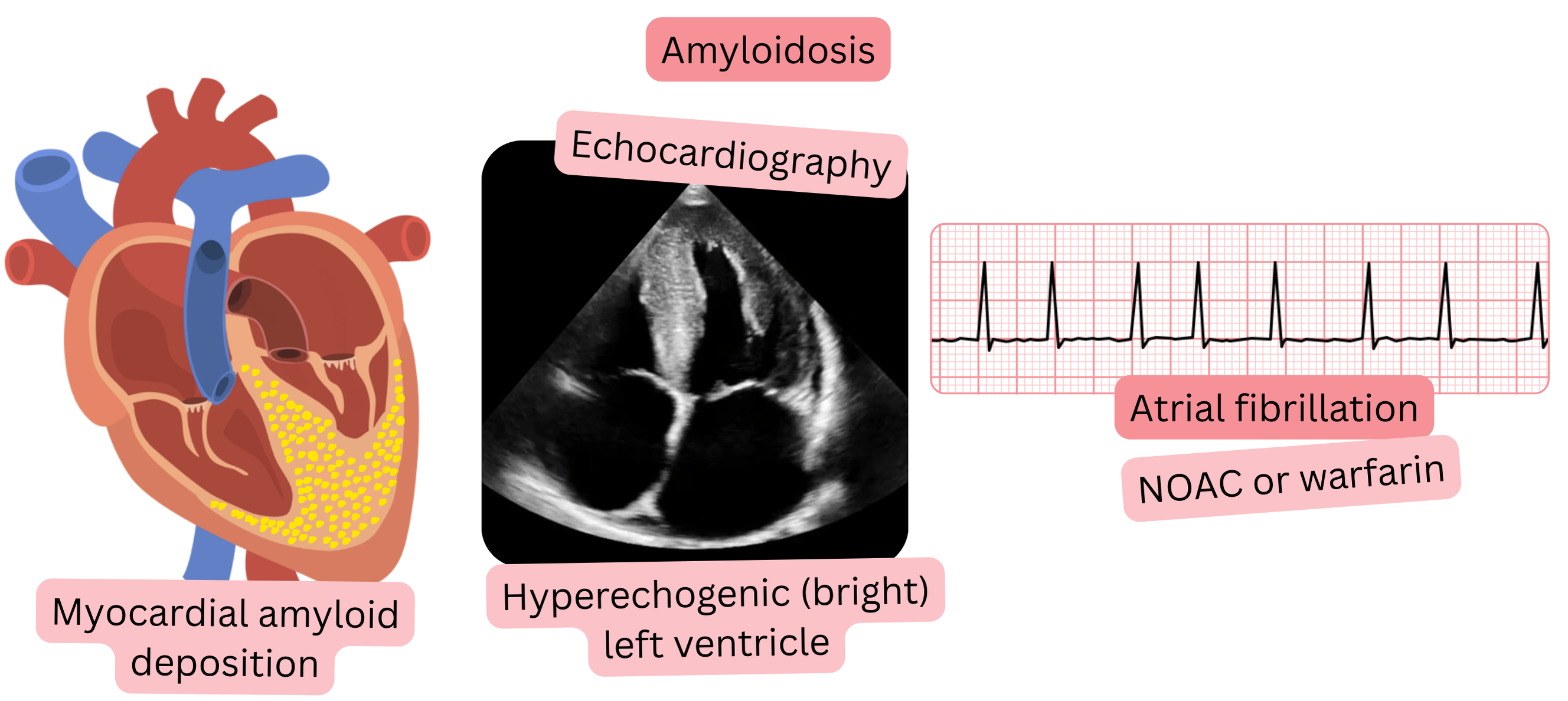 Illustration of atrial fibrillation in cardiac amyloidosis with a hyperechogenic left ventricle on echocardiography and indication for anticoagulation with NOACs or warfarin.