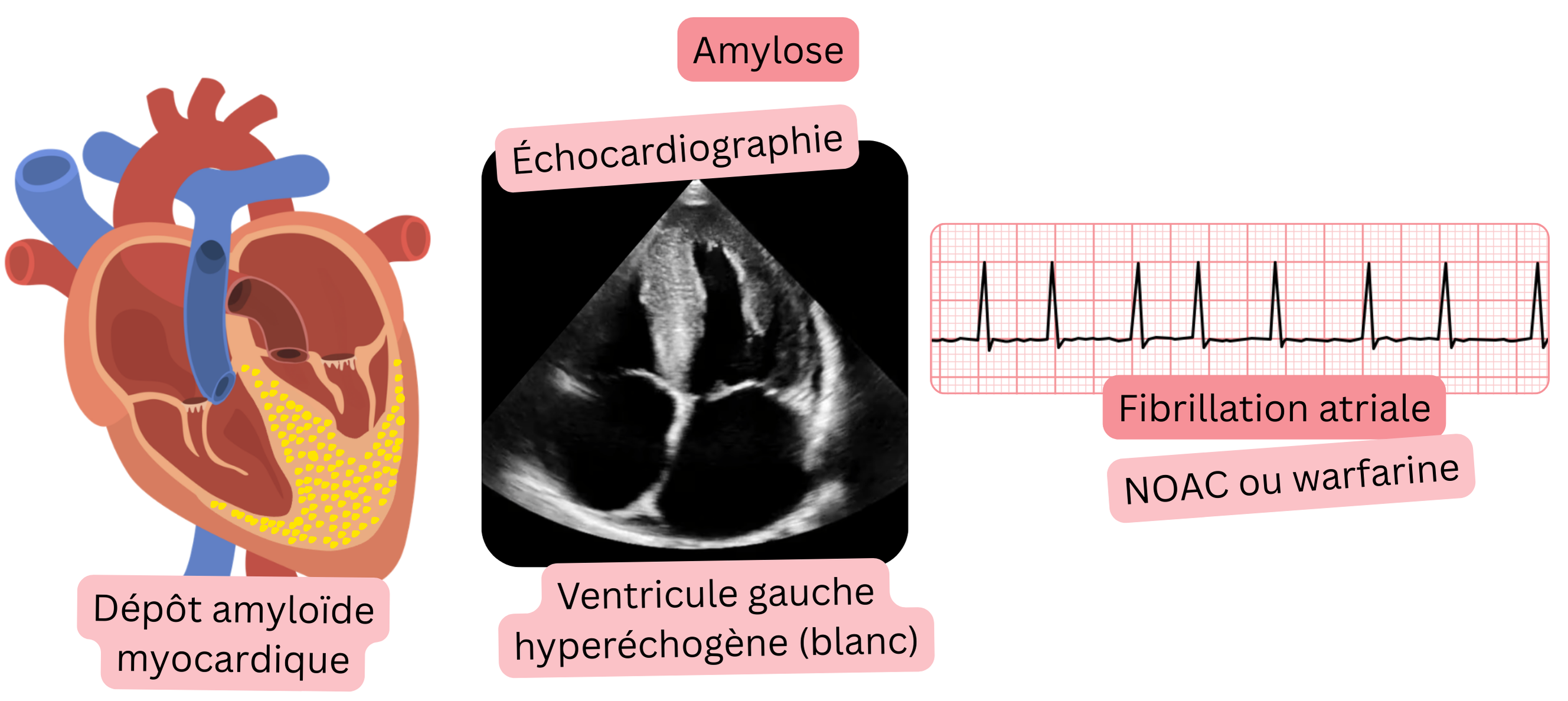 Illustration de la fibrillation atriale dans l’amylose cardiaque avec un ventricule gauche hyperéchogène à l’échocardiographie et une indication d’anticoagulation par AOD ou warfarine.