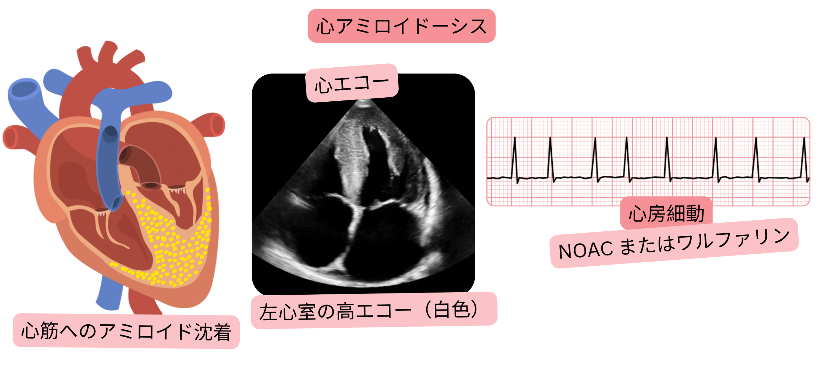 心臓アミロイドーシスに伴う心房細動を示し、心エコーで左心室の高エコー像と、NOACまたはワルファリンによる抗凝固療法の適応を示すイラスト。