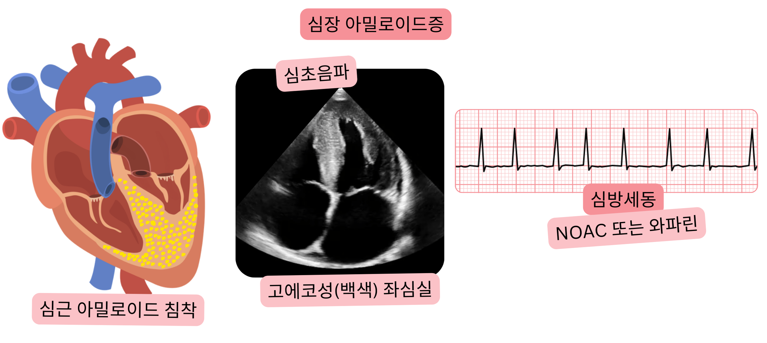 심장 아밀로이드증에서 발생한 심방세동과 심초음파에서 관찰되는 좌심실의 고에코 소견 및 NOAC 또는 와파린 항응고 치료 적응증을 보여주는 그림.