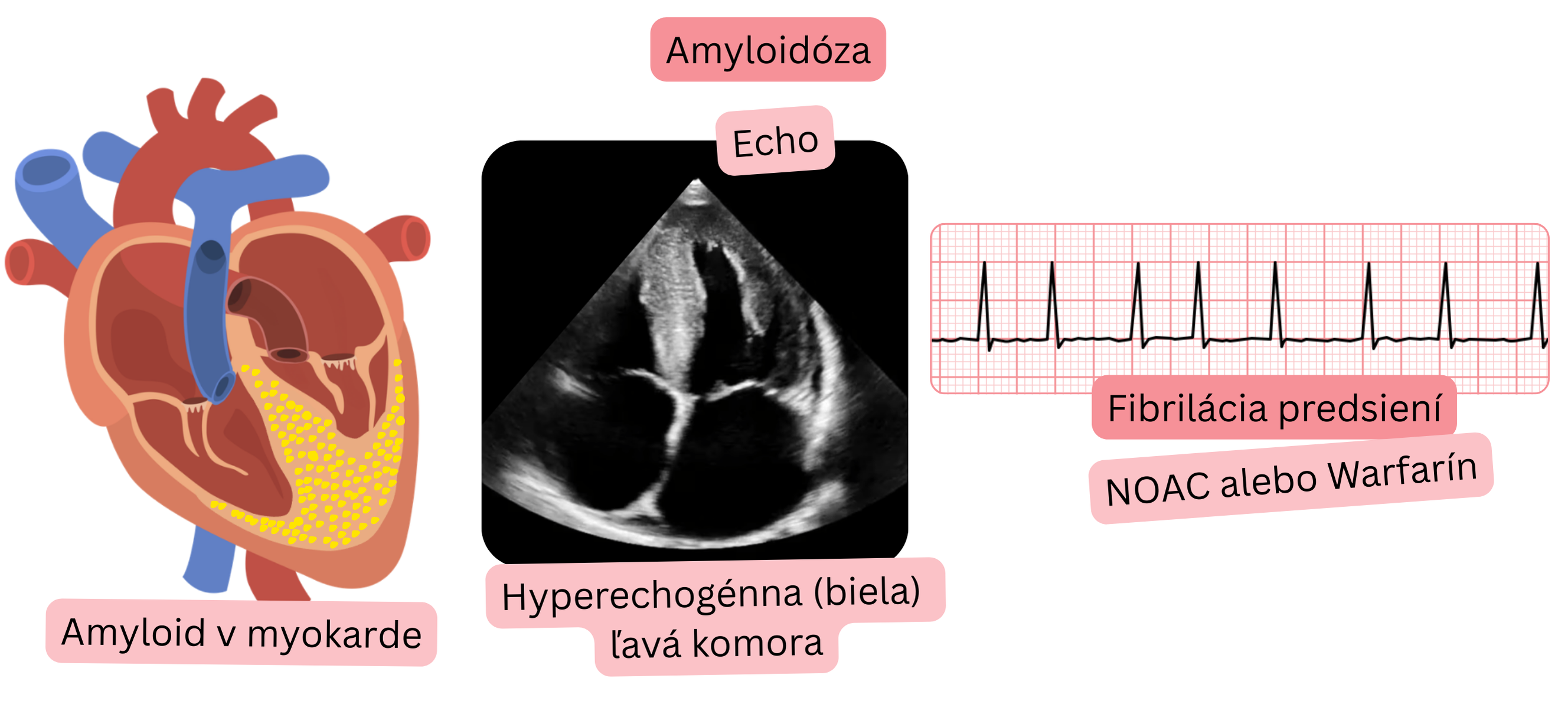 Ilustrácia fibrilácie predsiení pri srdcovej amyloidóze s hyperechogénnou ľavou komorou na echokardiografii a indikáciou antikoagulačnej liečby NOAC alebo warfarínom.