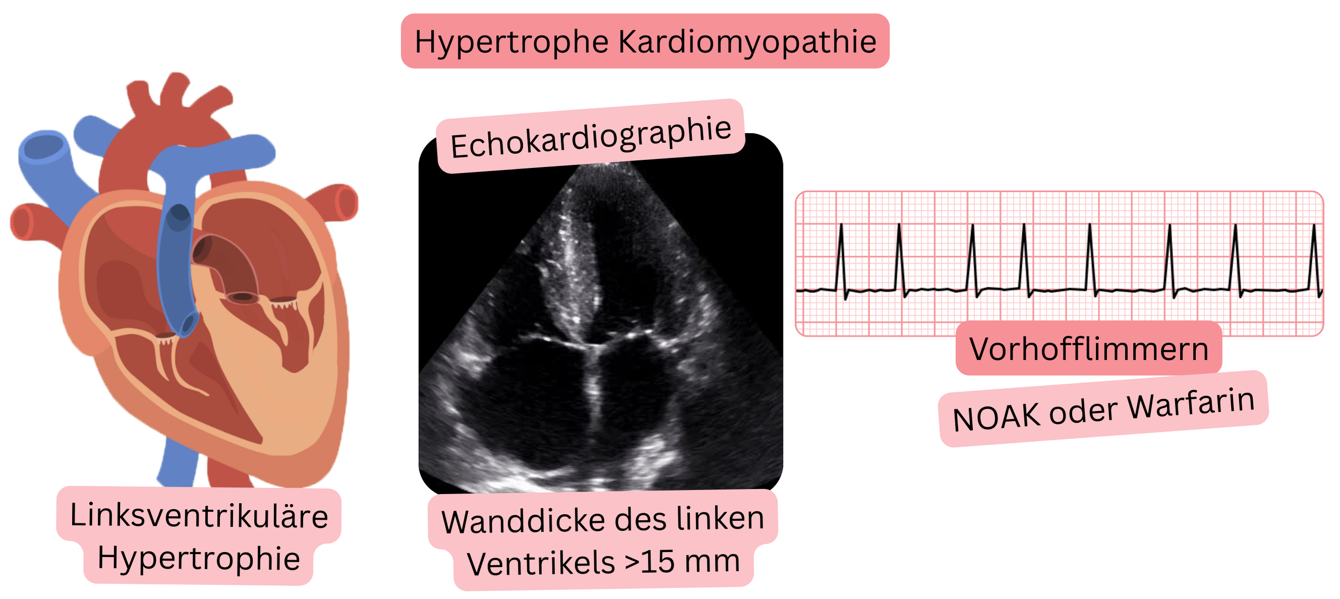 Illustration von Vorhofflimmern bei hypertropher Kardiomyopathie mit echokardiographischem Nachweis einer linksventrikulären Hypertrophie mit Wanddicke >15 mm und Indikation zur Antikoagulation mit NOAK oder Warfarin.