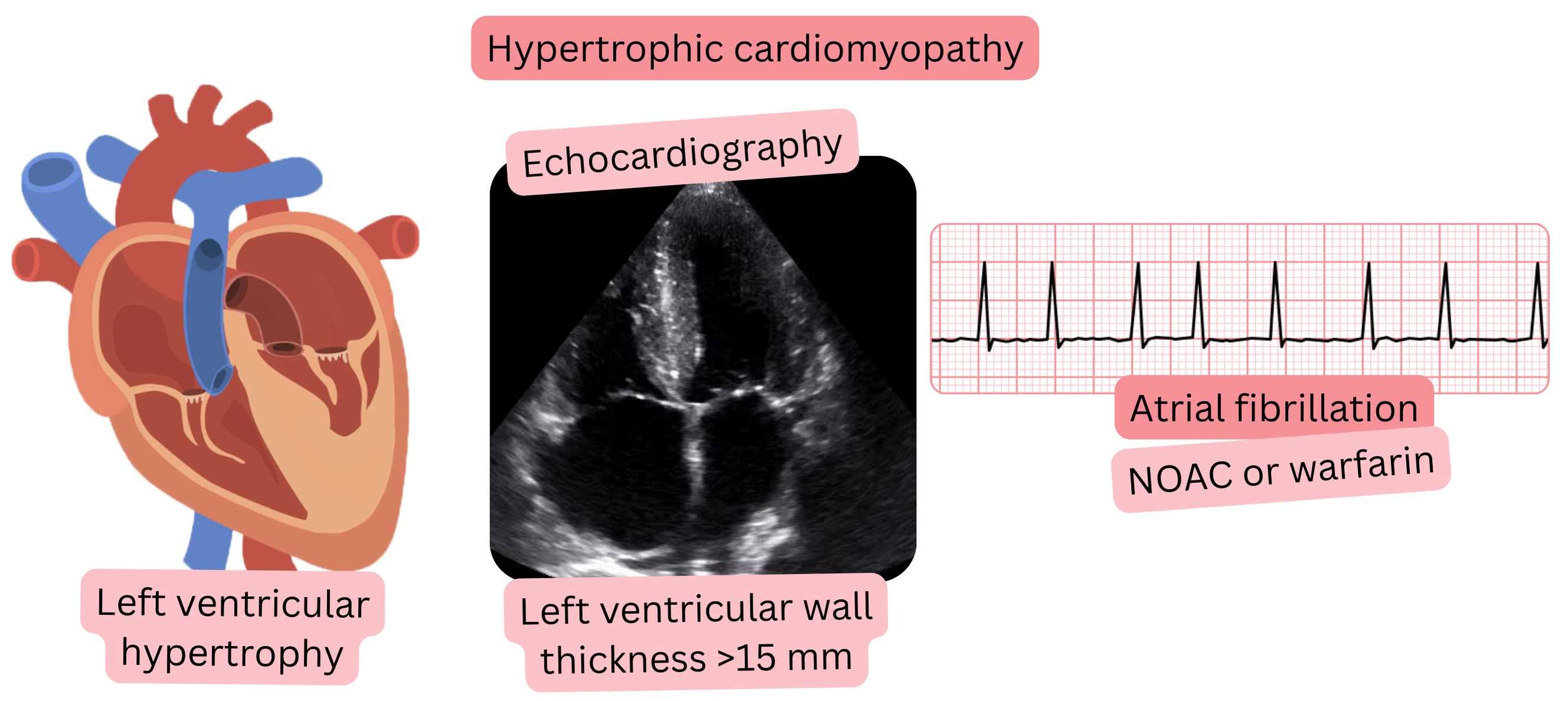 Illustration of atrial fibrillation in hypertrophic cardiomyopathy with echocardiographic evidence of left ventricular hypertrophy with wall thickness >15 mm and indication for anticoagulation with NOACs or warfarin.