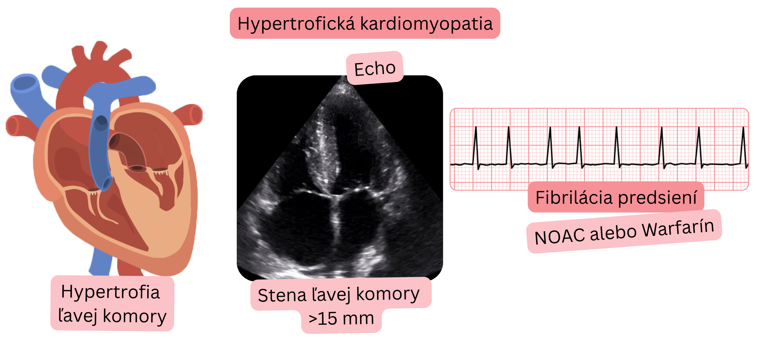 Ilustrácia fibrilácie predsiení pri hypertrofickej kardiomyopatii s echokardiografickým nálezom hypertrofie ľavej komory so stenou >15 mm a indikáciou antikoagulačnej liečby NOAC alebo warfarínom.