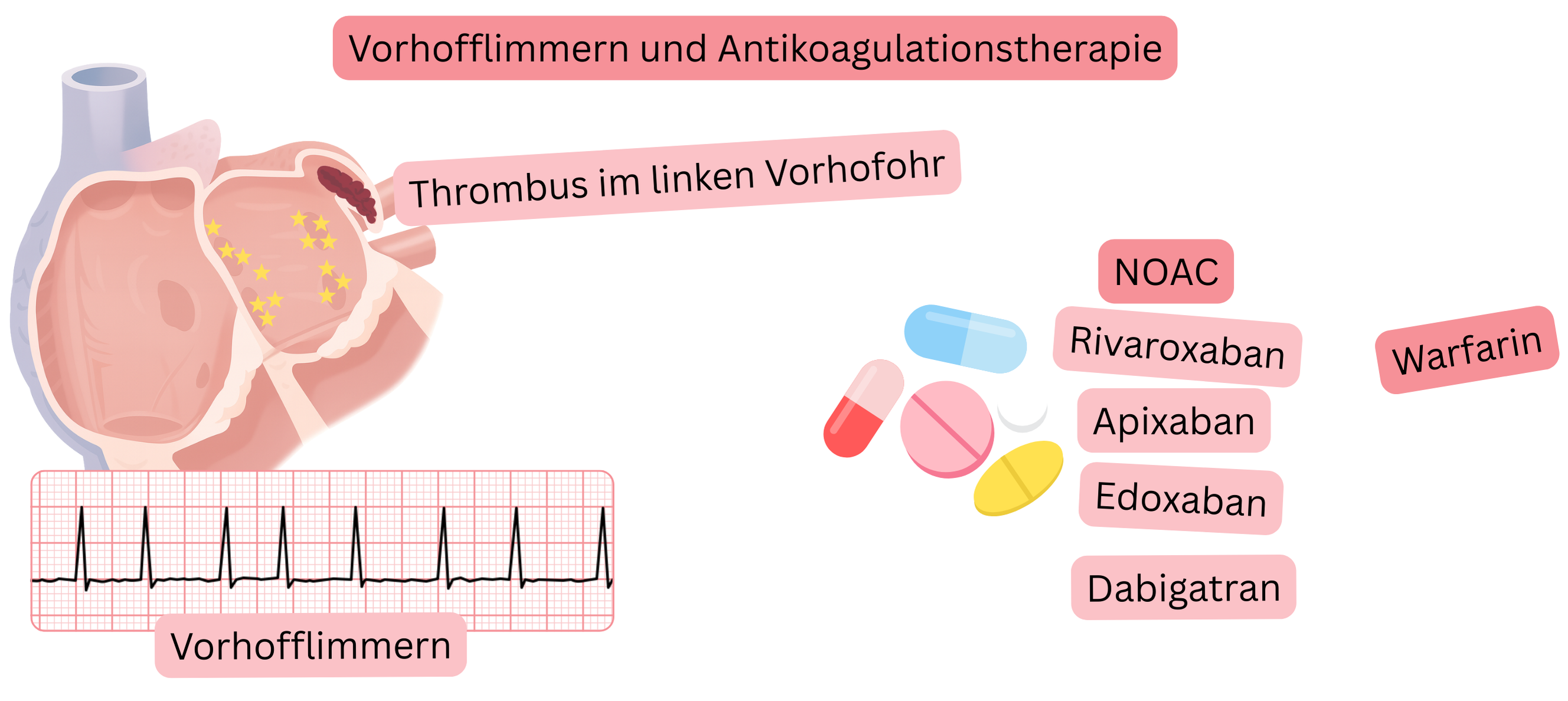 Infografik zur Darstellung von Vorhofflimmern mit Thrombus im linken Vorhofohr und den Prinzipien der Antikoagulation einschließlich NOAK und Warfarin.