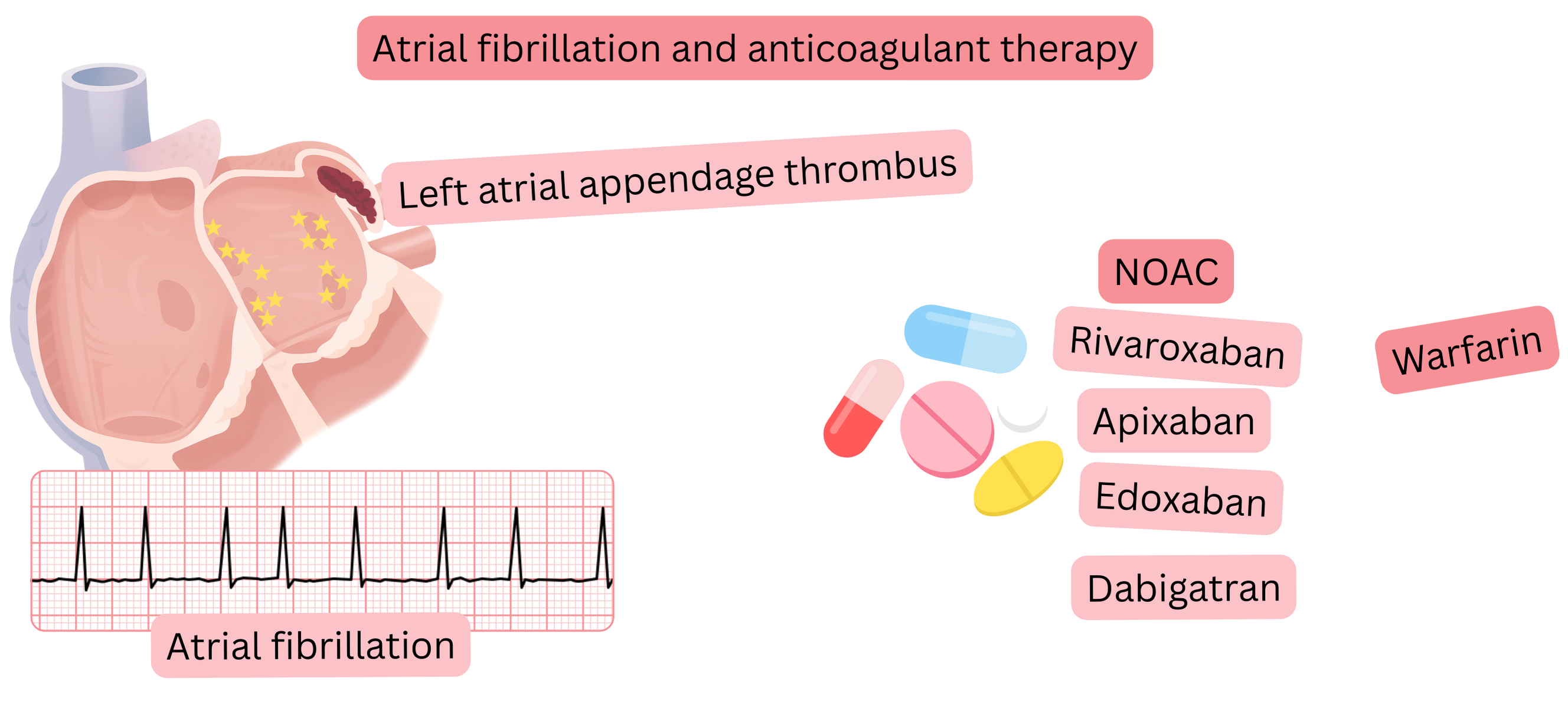 Infographic illustrating atrial fibrillation with a thrombus in the left atrial appendage and the principles of anticoagulation therapy including NOACs and warfarin.