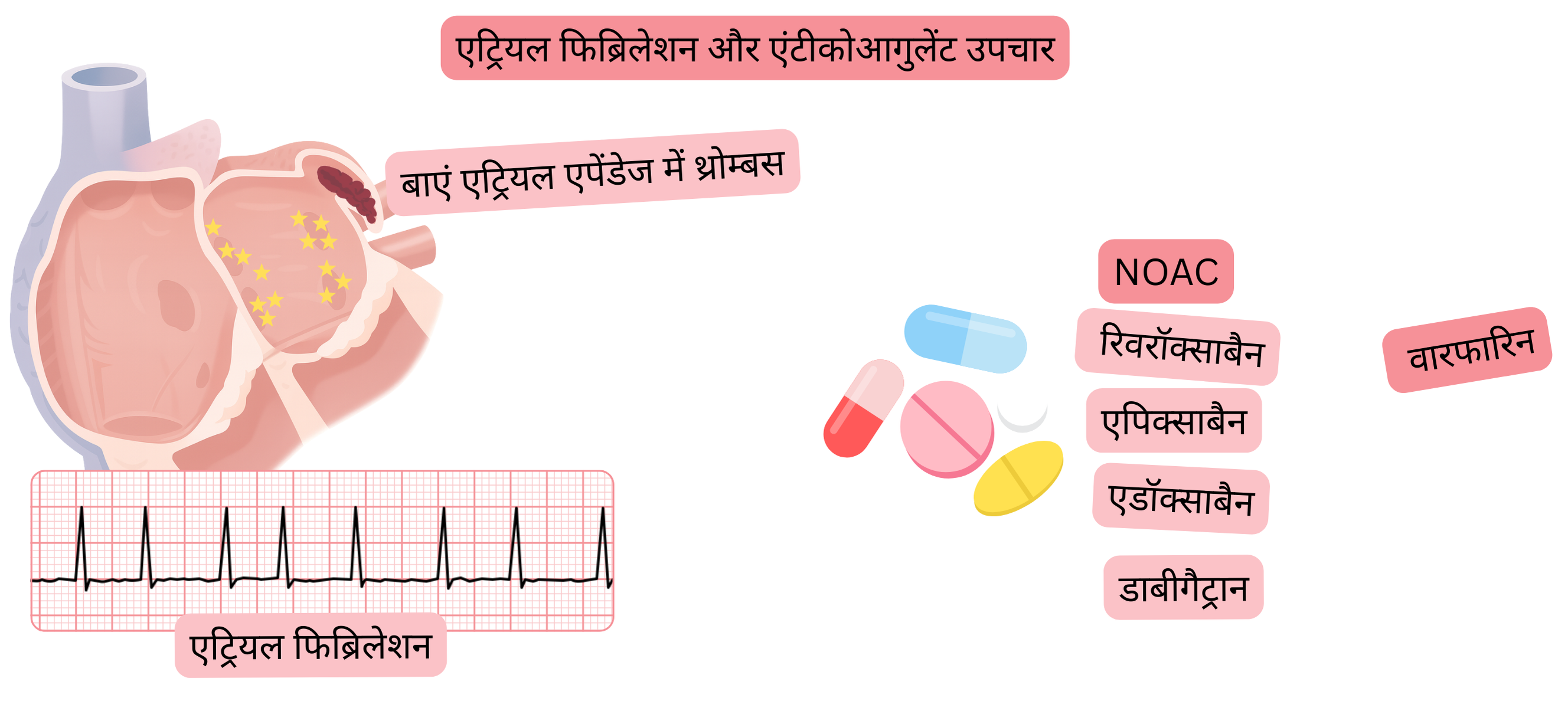 यह इन्फोग्राफिक एट्रियल फिब्रिलेशन में बाएं आलिंद उपांग के थ्रोम्बस तथा NOAC और वारफारिन सहित एंटीकॉगुलेंट उपचार के सिद्धांतों को दर्शाता है।