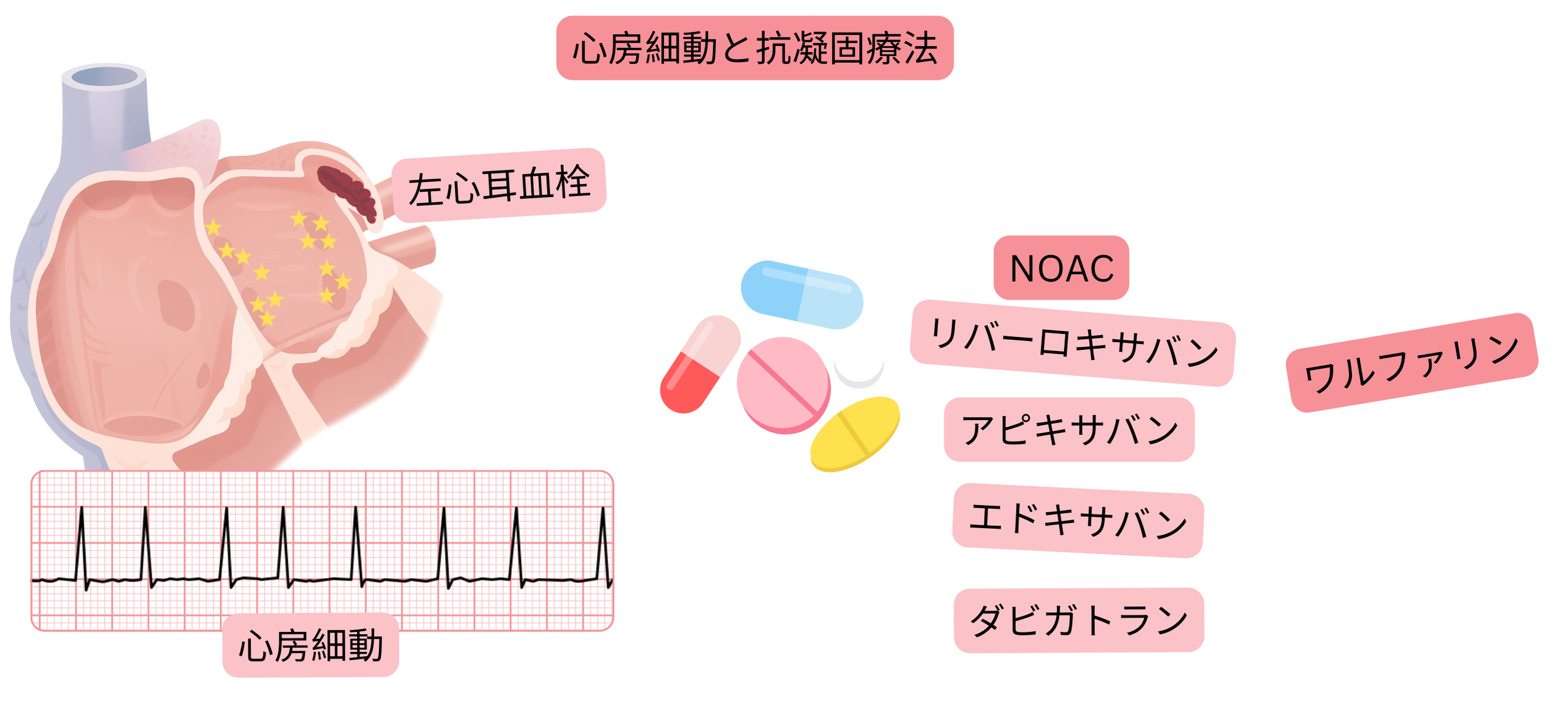 左心耳血栓を伴う心房細動と、NOACおよびワルファリンを含む抗凝固療法の原則を示すインフォグラフィック。