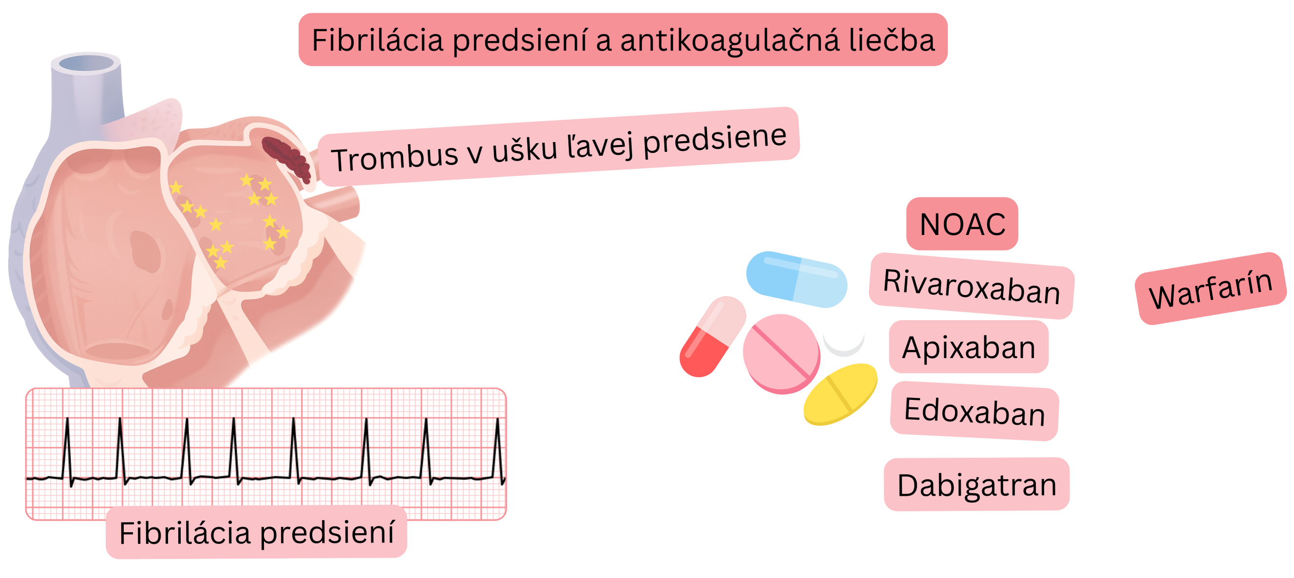 Infografika znázorňujúca fibriláciu predsiení s trombom v ušku ľavej predsiene a princípy antikoagulačnej liečby vrátane NOAC a warfarínu.