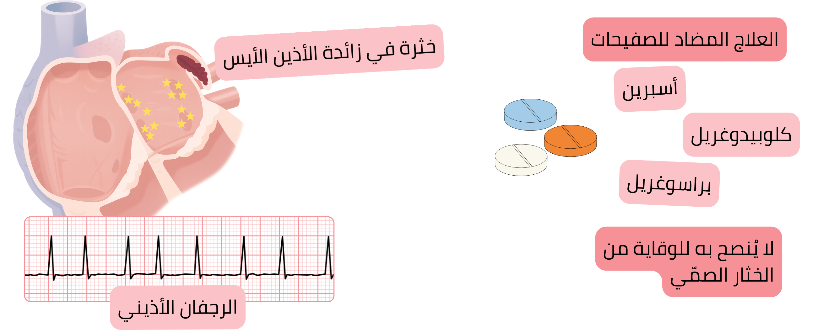 إنفوجرافيك يوضح الرجفان الأذيني مع خثرة في زائدة الأذين الأيسر والتنبيه إلى أن العلاج المضاد للصفيحات غير موصى به للوقاية من الخثار الصمي.