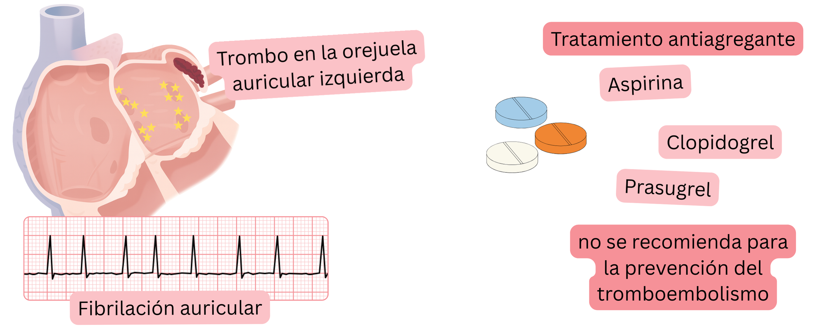 Infografía que muestra la fibrilación auricular con trombo en la orejuela auricular izquierda y advierte que la terapia antiagregante no está recomendada para la prevención del tromboembolismo.
