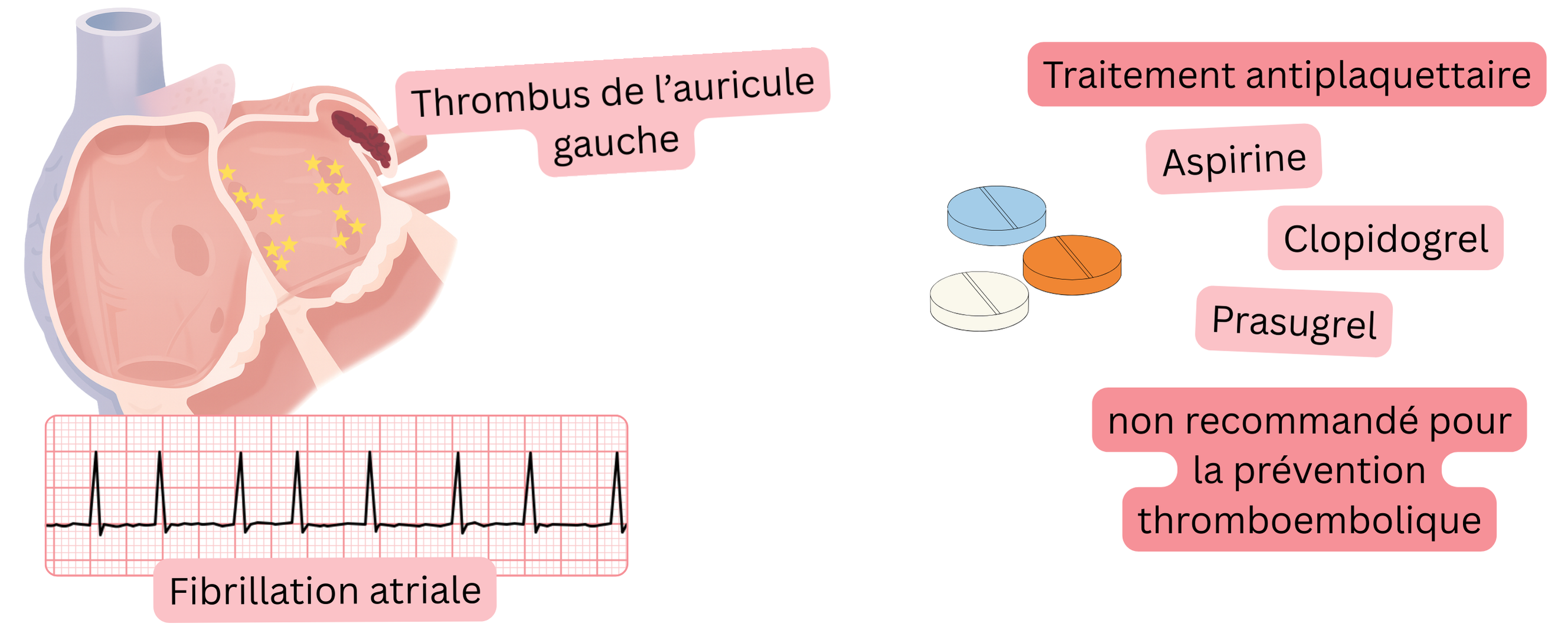 Infographie illustrant la fibrillation atriale avec un thrombus dans l’appendice auriculaire gauche et avertissant que le traitement antiplaquettaire n’est pas recommandé pour la prévention du thromboembolie.