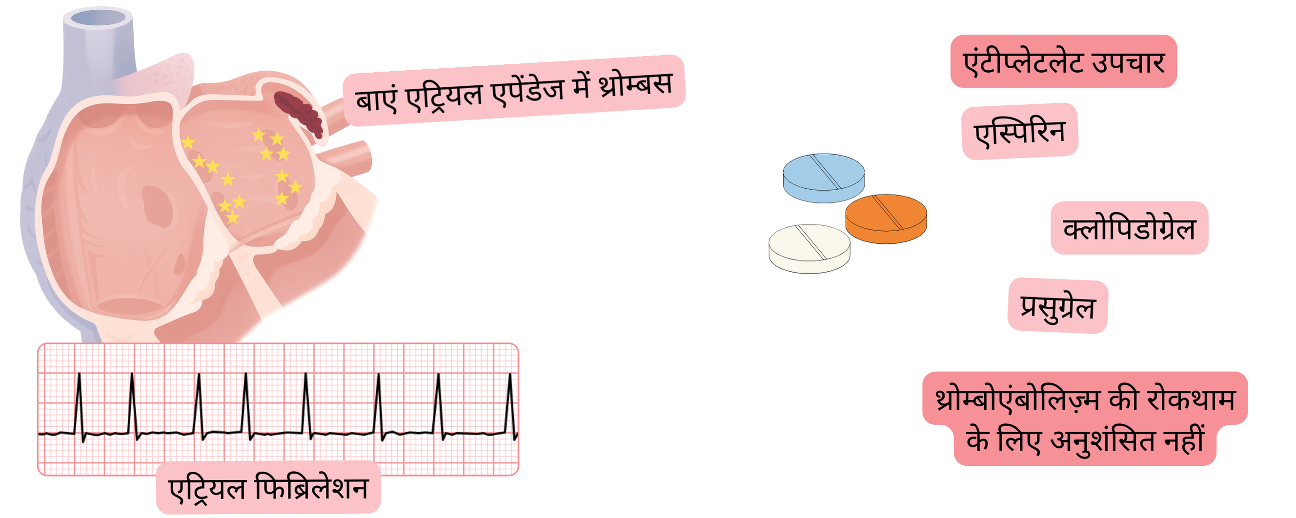 यह इन्फोग्राफिक एट्रियल फिब्रिलेशन में बाएं आलिंद उपांग के थ्रोम्बस को दर्शाता है और यह चेतावनी देता है कि थ्रोम्बोएम्बोलिज़्म की रोकथाम के लिए एंटीप्लेटलेट उपचार की सिफारिश नहीं की जाती।