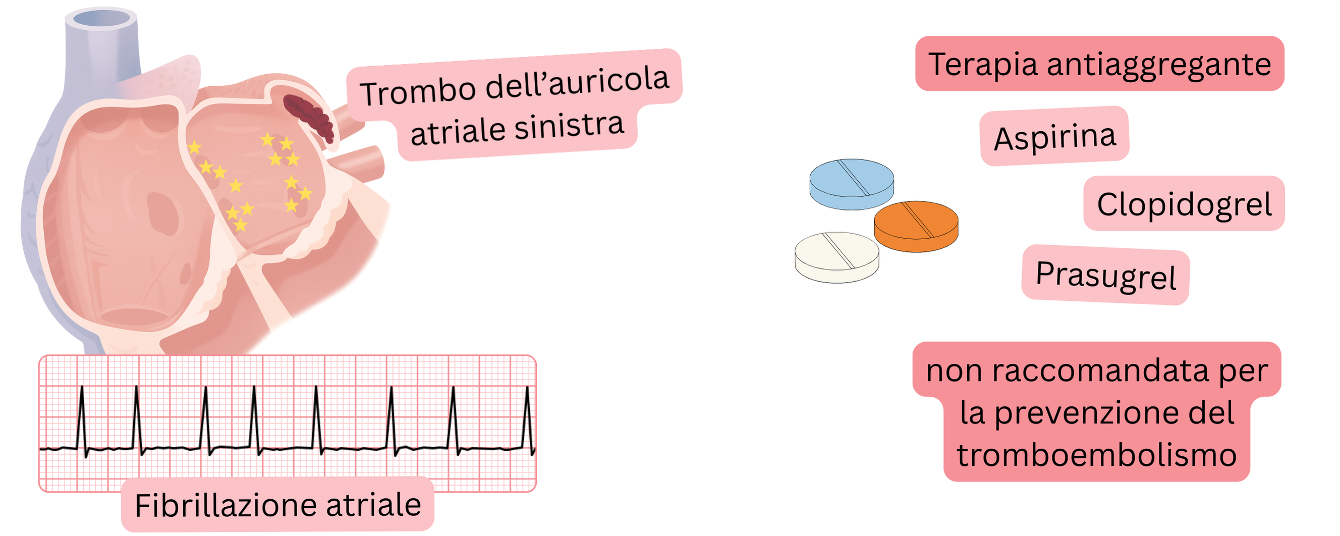 Infografica che illustra la fibrillazione atriale con trombo nell’auricola atriale sinistra e avverte che la terapia antiaggregante non è raccomandata per la prevenzione del tromboembolismo.