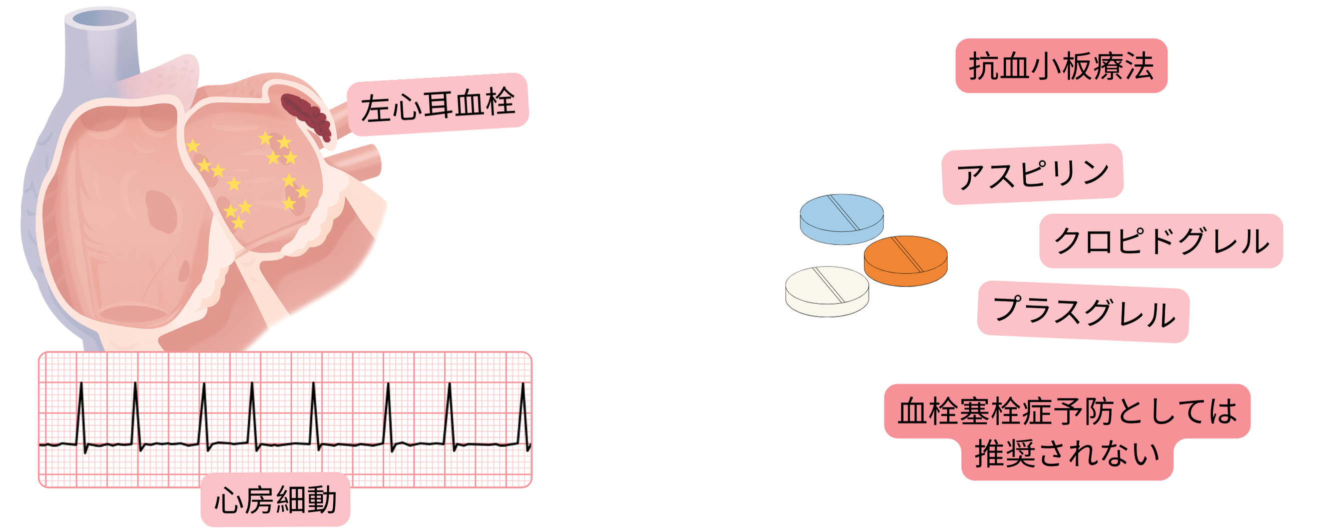 左心耳血栓を伴う心房細動を示し、血栓塞栓症予防に抗血小板療法は推奨されないことを注意喚起するインフォグラフィック。