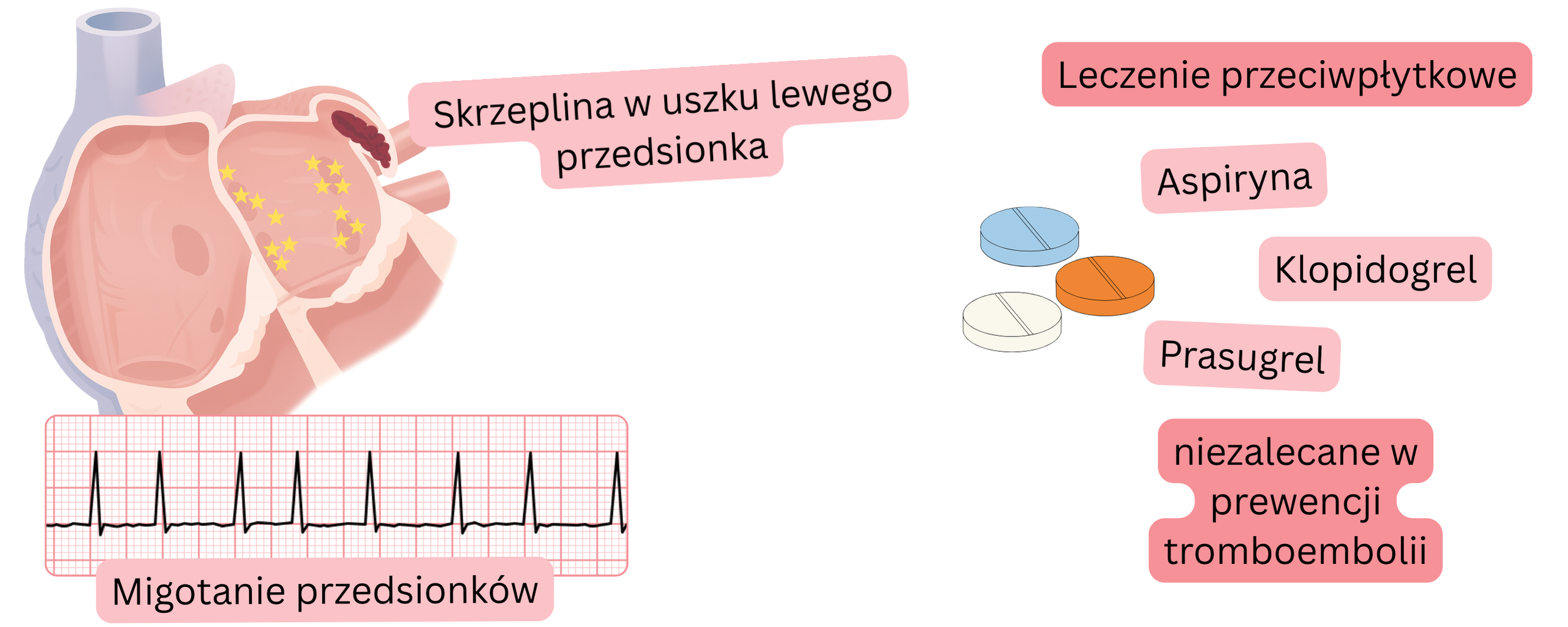 Infografika przedstawiająca migotanie przedsionków z zakrzepem w uszku lewego przedsionka oraz ostrzeżenie, że leczenie przeciwpłytkowe nie jest zalecane w prewencji powikłań zakrzepowo-zatorowych.