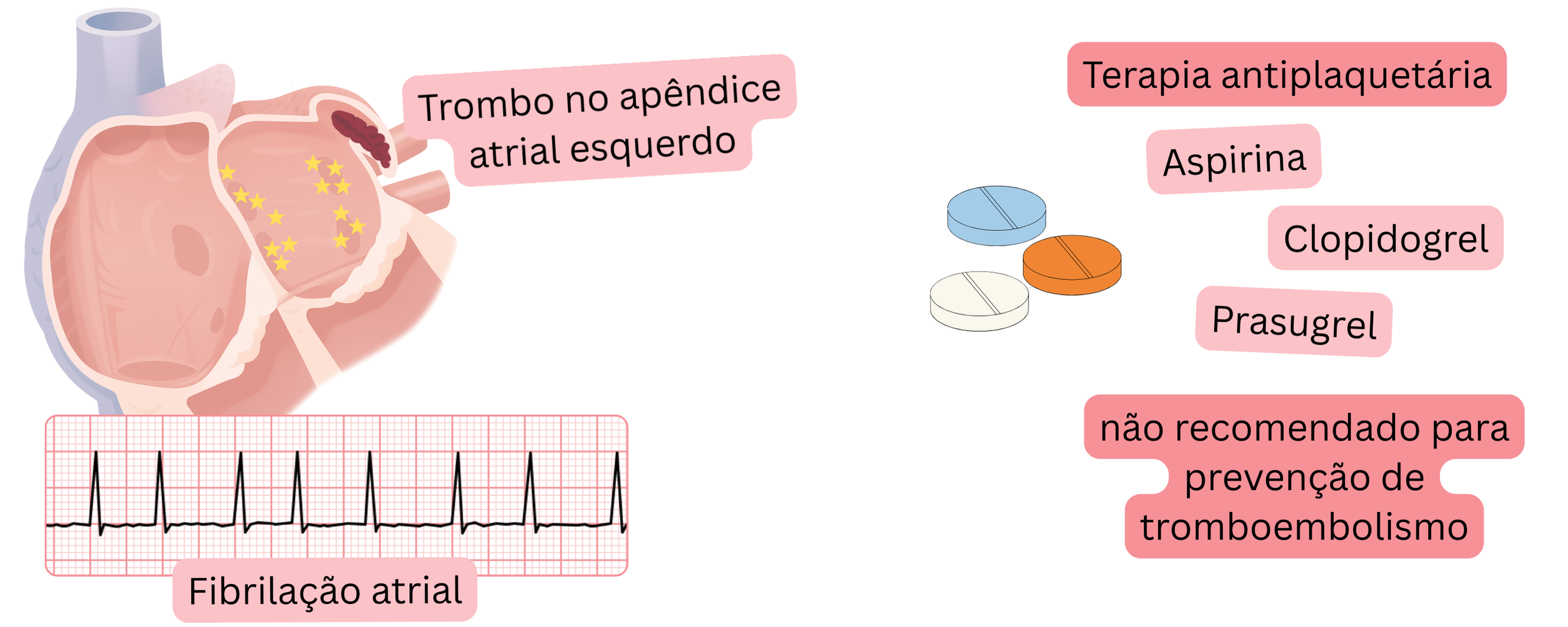 Infográfico que ilustra a fibrilação atrial com trombo no apêndice atrial esquerdo e alerta que a terapia antiplaquetária não é recomendada para a prevenção do tromboembolismo.