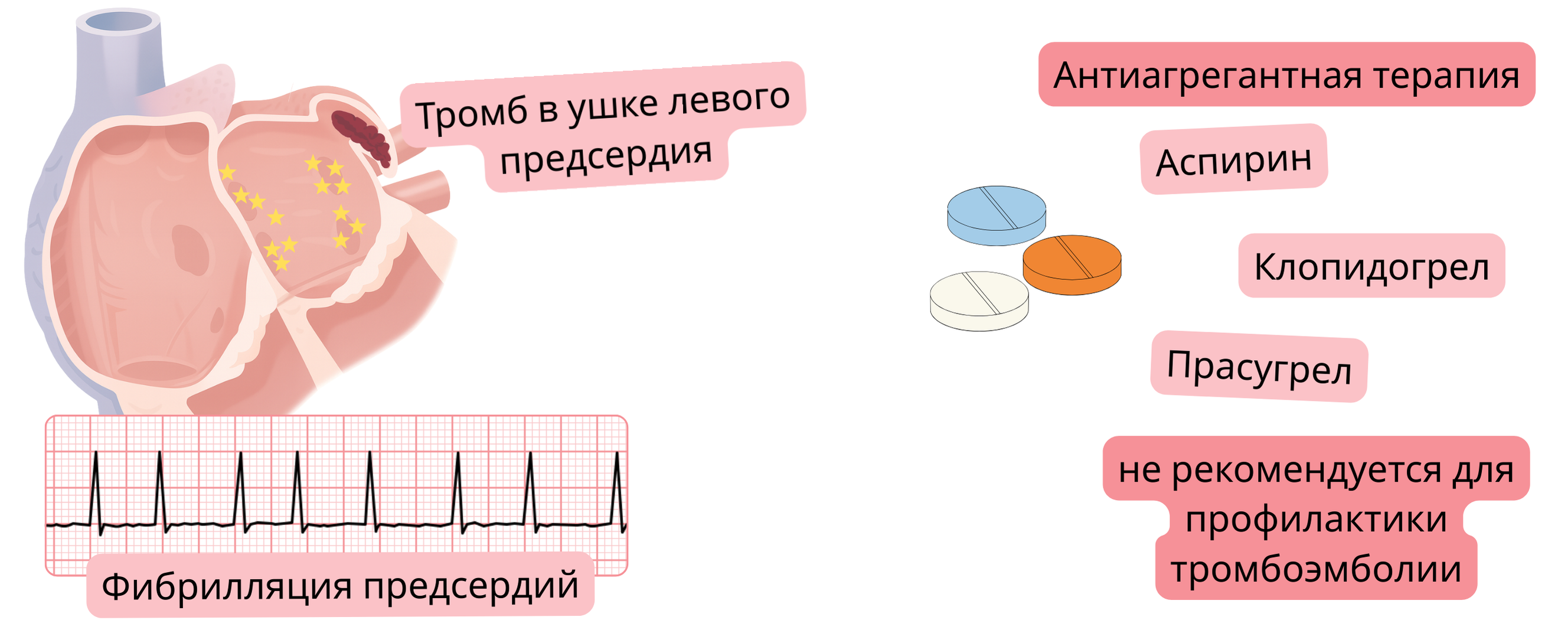 Инфографика, демонстрирующая фибрилляцию предсердий с тромбом в ушке левого предсердия и предупреждение о том, что антиагрегантная терапия не рекомендуется для профилактики тромбоэмболии.