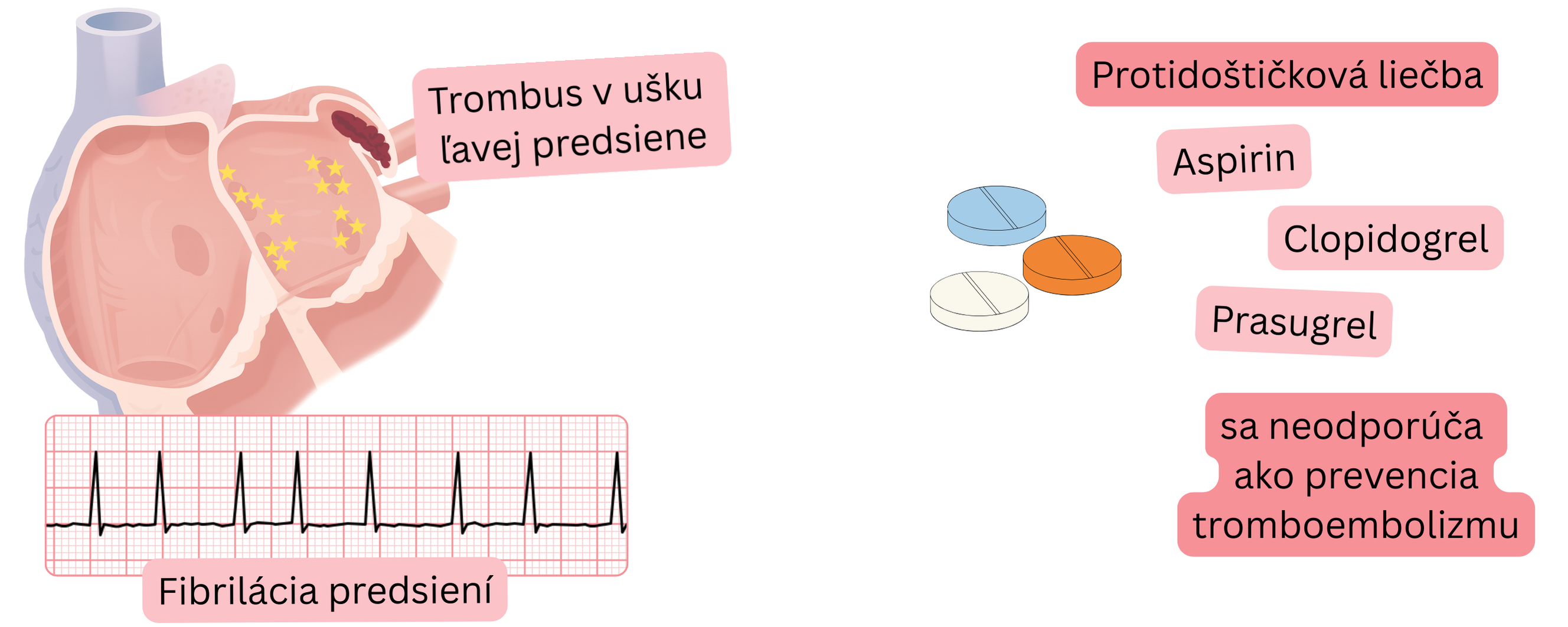 Infografika zobrazujúca fibriláciu predsiení s trombom v ušku ľavej predsiene a upozornenie, že protidoštičková liečba nie je odporúčaná na prevenciu tromboembolizmu.