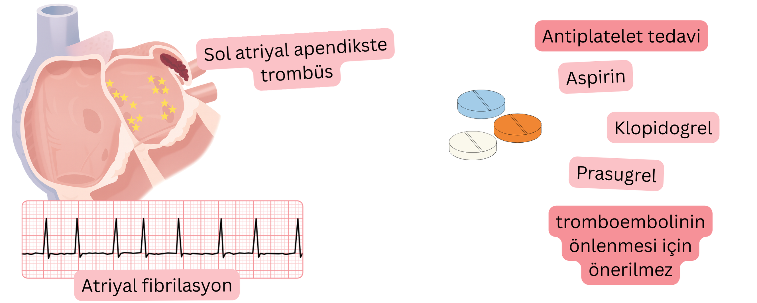 Sol atriyal apendikste trombüs ile atriyal fibrilasyonu gösteren ve tromboemboli profilaksisinde antiagregan tedavinin önerilmediğini vurgulayan infografik.