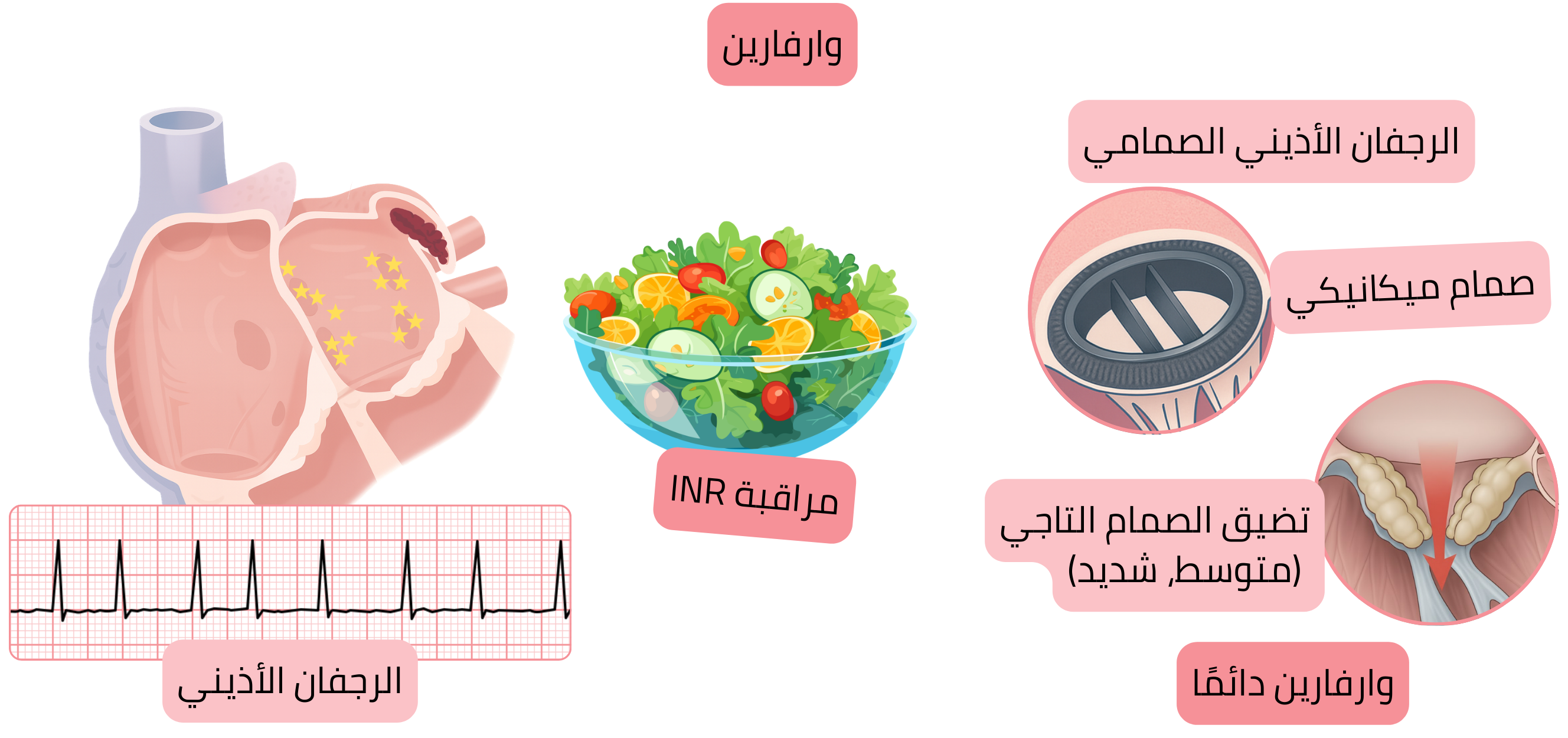 إنفوجرافيك يوضح الرجفان الأذيني مع خثرة في زائدة الأذين الأيسر، ودواعي استخدام الوارفارين في الرجفان الأذيني الصمامي بما في ذلك الصمامات الميكانيكية وتضيق الصمام التاجي المتوسط إلى الشديد، مع التأكيد على مراقبة INR.