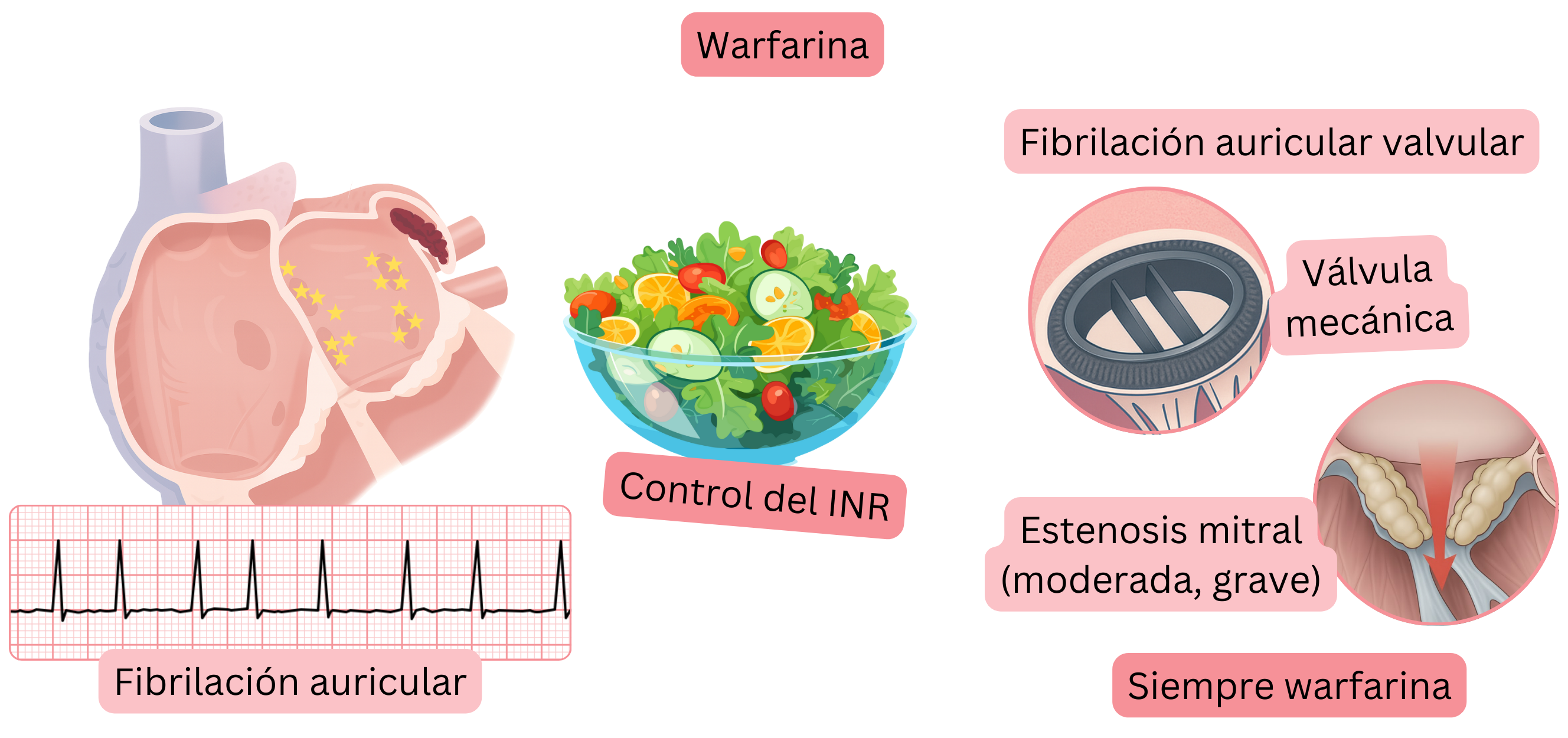 Infografía que muestra la fibrilación auricular con trombo en la orejuela auricular izquierda, la indicación de warfarina en la fibrilación auricular valvular, incluidas las válvulas mecánicas y la estenosis mitral moderada a grave, con énfasis en el control del INR.