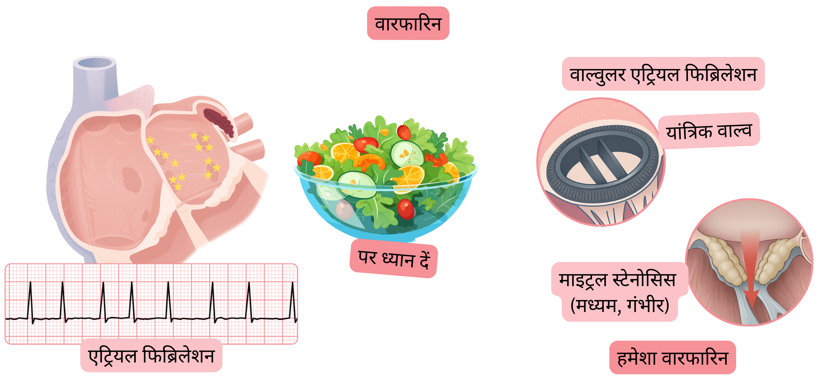यह इन्फोग्राफिक बाएं आलिंद उपांग में थ्रोम्बस के साथ एट्रियल फिब्रिलेशन, वाल्वुलर एट्रियल फिब्रिलेशन में वारफारिन की संकेतना (जिसमें यांत्रिक वाल्व और मध्यम से गंभीर माइट्रल स्टेनोसिस शामिल हैं) तथा INR मॉनिटरिंग के महत्व को दर्शाता है।