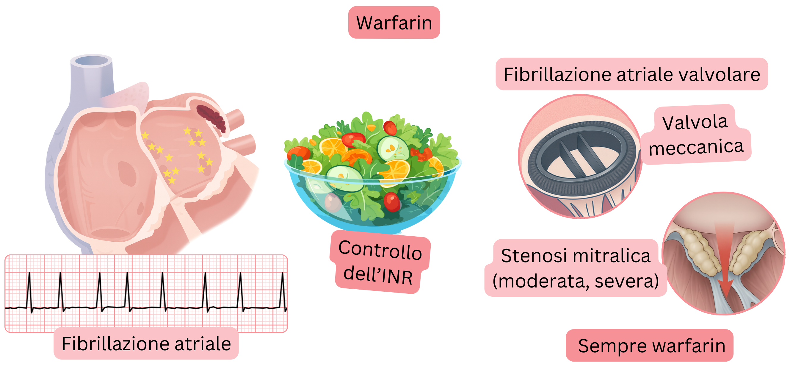 Infografica che illustra la fibrillazione atriale con trombo nell’auricola atriale sinistra, l’indicazione al warfarin nella fibrillazione atriale valvolare, comprese le valvole meccaniche e la stenosi mitralica da moderata a grave, con enfasi sul monitoraggio dell’INR.