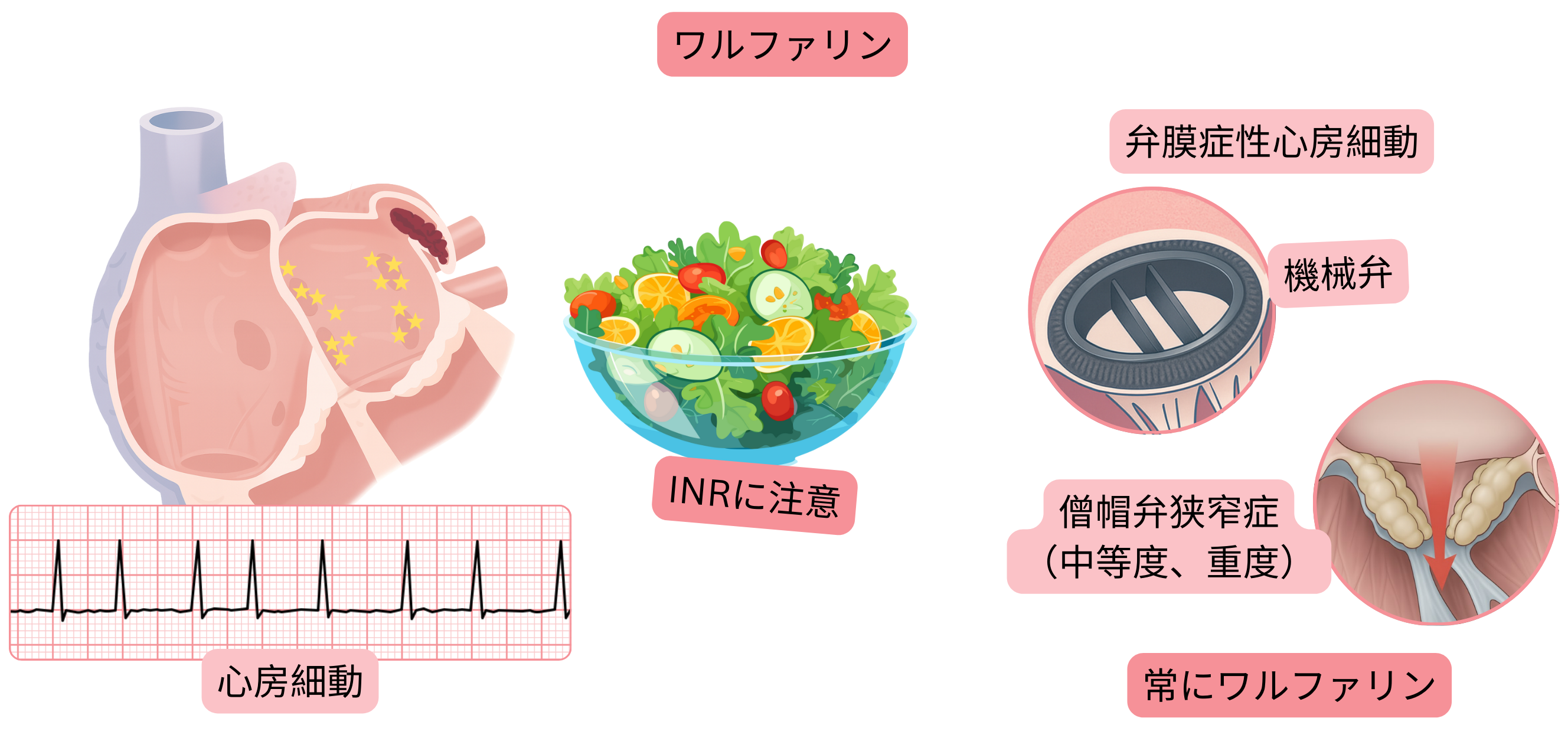 左心耳血栓を伴う心房細動と、機械弁および中等度から重度の僧帽弁狭窄を含む弁膜症性心房細動におけるワルファリン適応、ならびにINRモニタリングの重要性を示すインフォグラフィック。