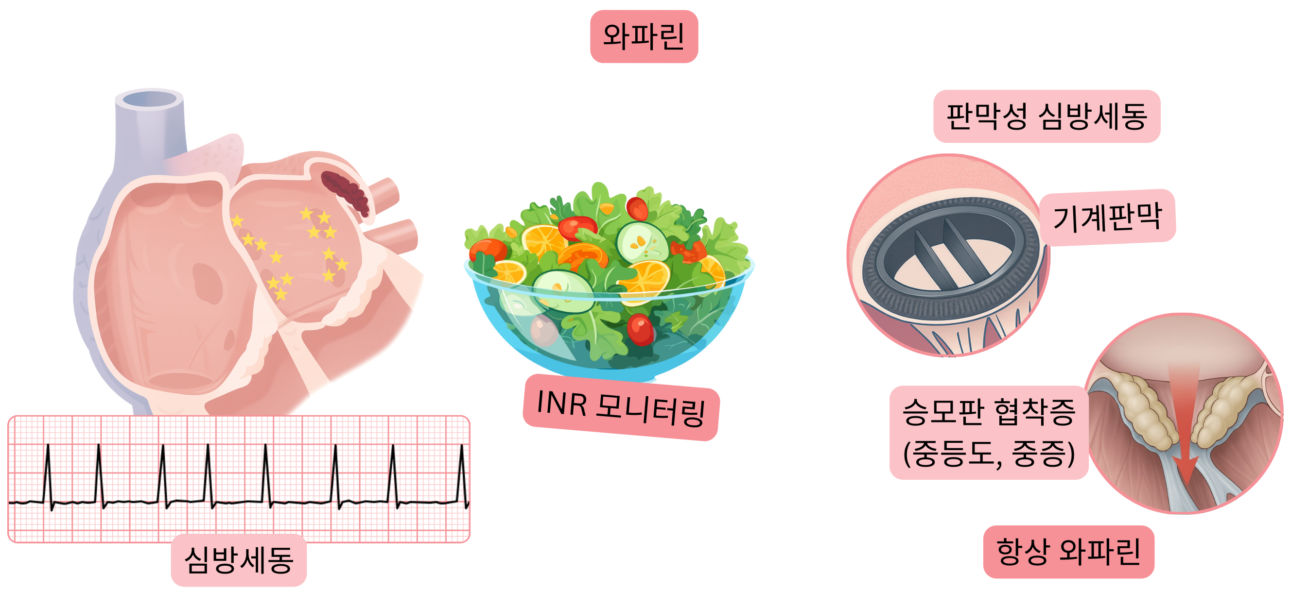 좌심방이 부속기 혈전을 동반한 심방세동과 기계판막 및 중등도에서 중증의 승모판 협착증을 포함한 판막성 심방세동에서 와파린 적응증, 그리고 INR 모니터링의 중요성을 강조한 인포그래픽.