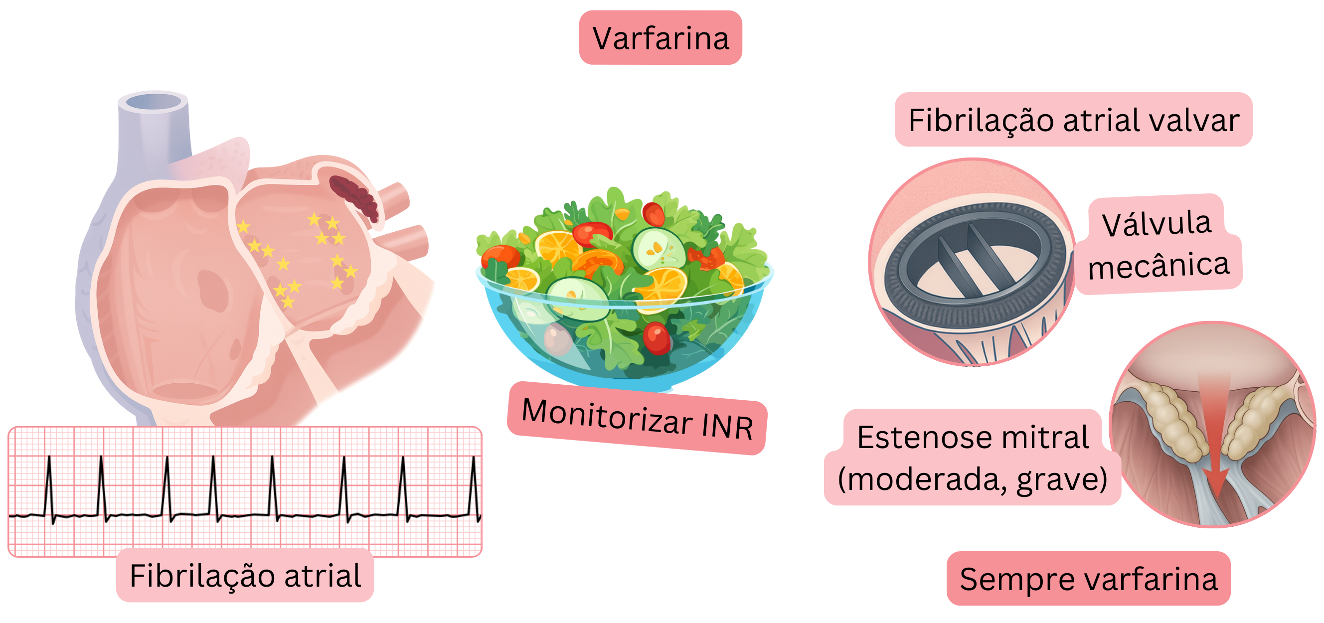 Infográfico que ilustra a fibrilação atrial com trombo no apêndice atrial esquerdo, a indicação de varfarina na fibrilação atrial valvar, incluindo válvulas mecânicas e estenose mitral moderada a grave, com ênfase no monitoramento do INR.
