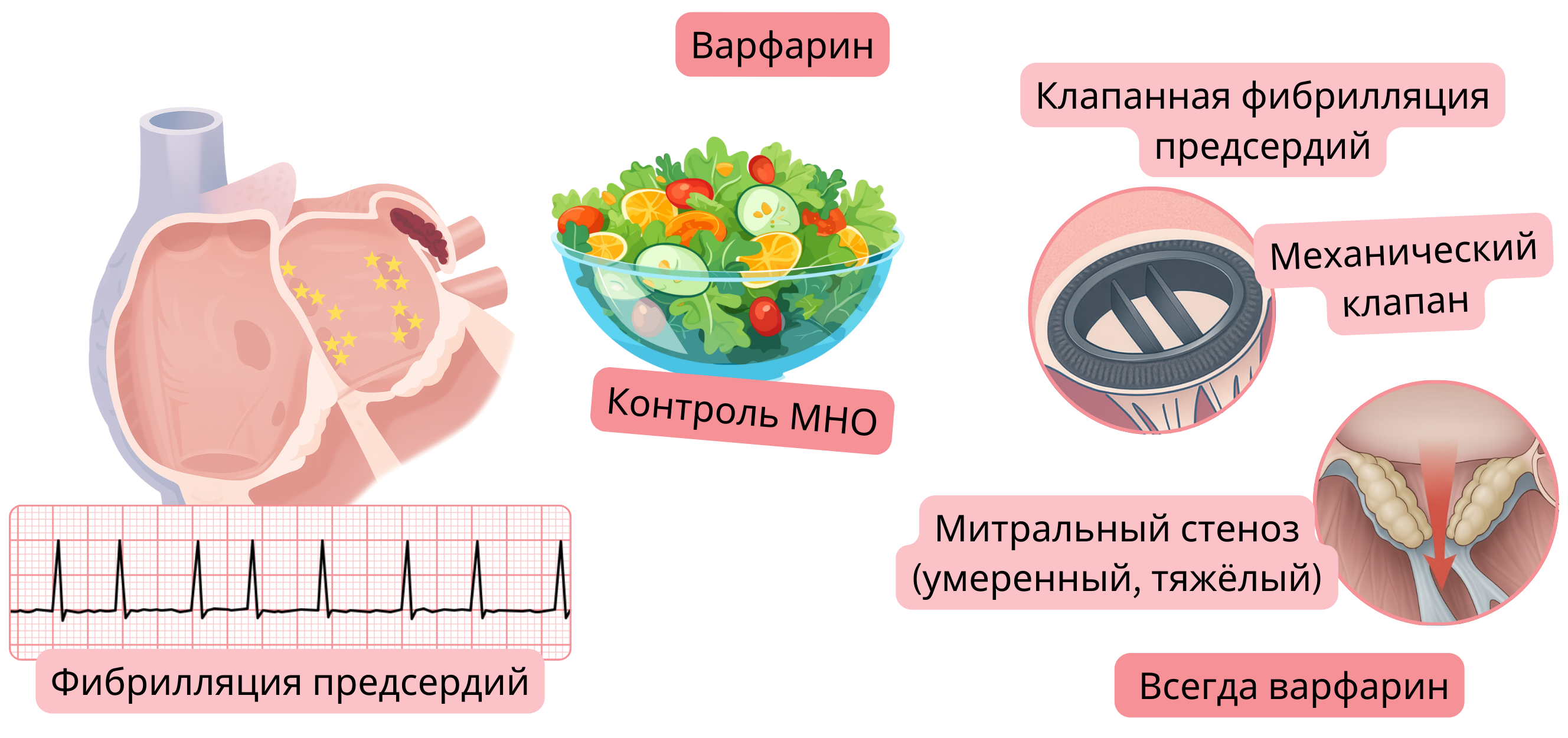 Инфографика, демонстрирующая фибрилляцию предсердий с тромбом в ушке левого предсердия, показания к варфарину при клапанной фибрилляции предсердий, включая механические клапаны и умеренный–тяжелый митральный стеноз, с акцентом на мониторинг МНО.