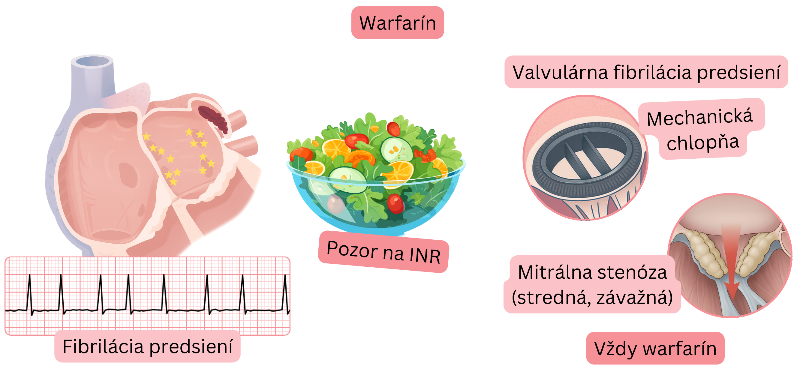 Infografika znázorňujúca fibriláciu predsiení s trombom v ušku ľavej predsiene, indikáciu warfarínu pri valvulárnej fibrilácii predsiení vrátane mechanickej chlopne a strednej až závažnej mitrálnej stenózy s dôrazom na monitorovanie INR.