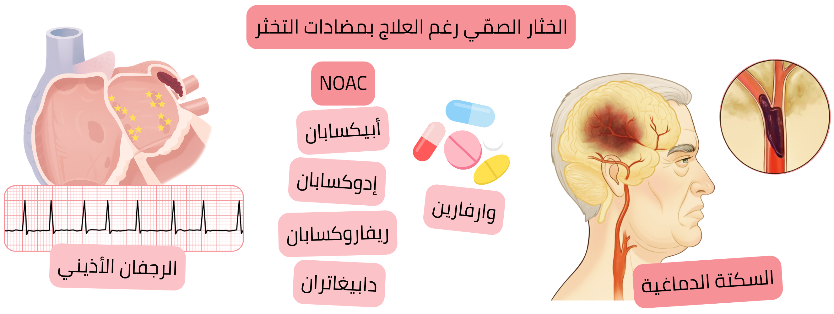 إنفوجرافيك يوضح حدوث الخثار الصمي رغم العلاج المضاد للتخثر لدى مريض مصاب بالرجفان الأذيني، بما في ذلك العلاج بمضادات التخثر الفموية الحديثة أو الوارفارين، وحدوث سكتة دماغية إقفارية.