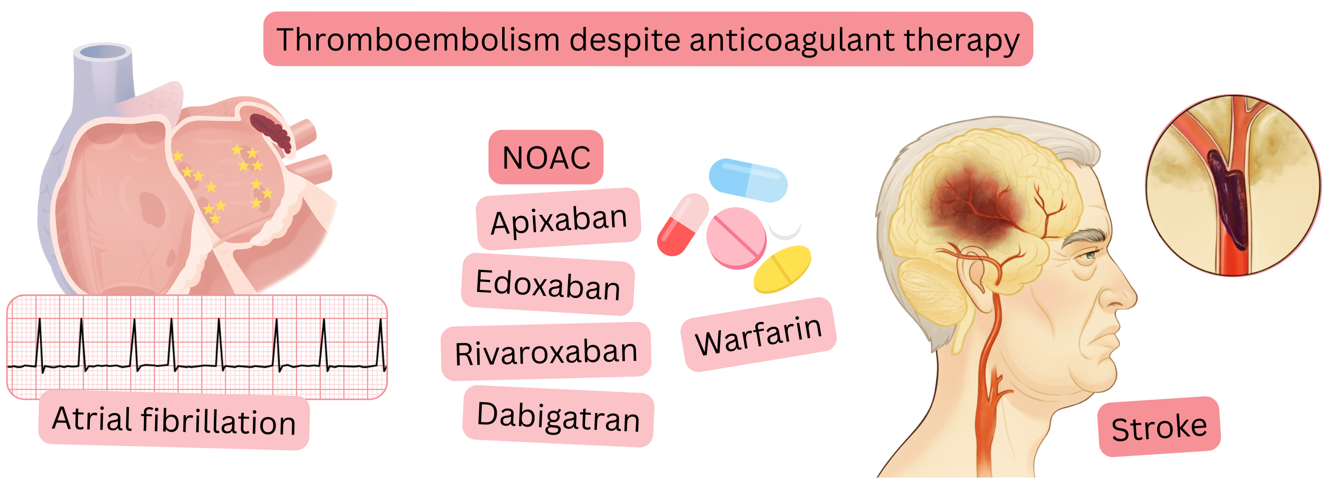 Infographic illustrating thromboembolism despite anticoagulation therapy in a patient with atrial fibrillation, including treatment with NOACs or warfarin and the occurrence of ischemic stroke.