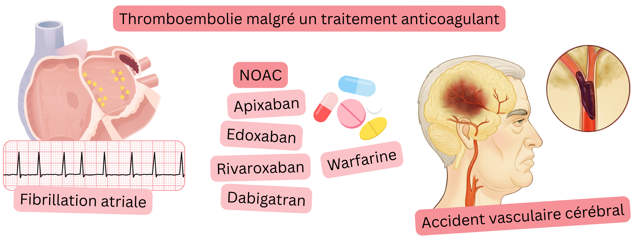 Infographie illustrant un thromboembolie survenant malgré un traitement anticoagulant chez un patient atteint de fibrillation atriale, incluant les AOD ou la warfarine, avec survenue d’un accident vasculaire cérébral ischémique.