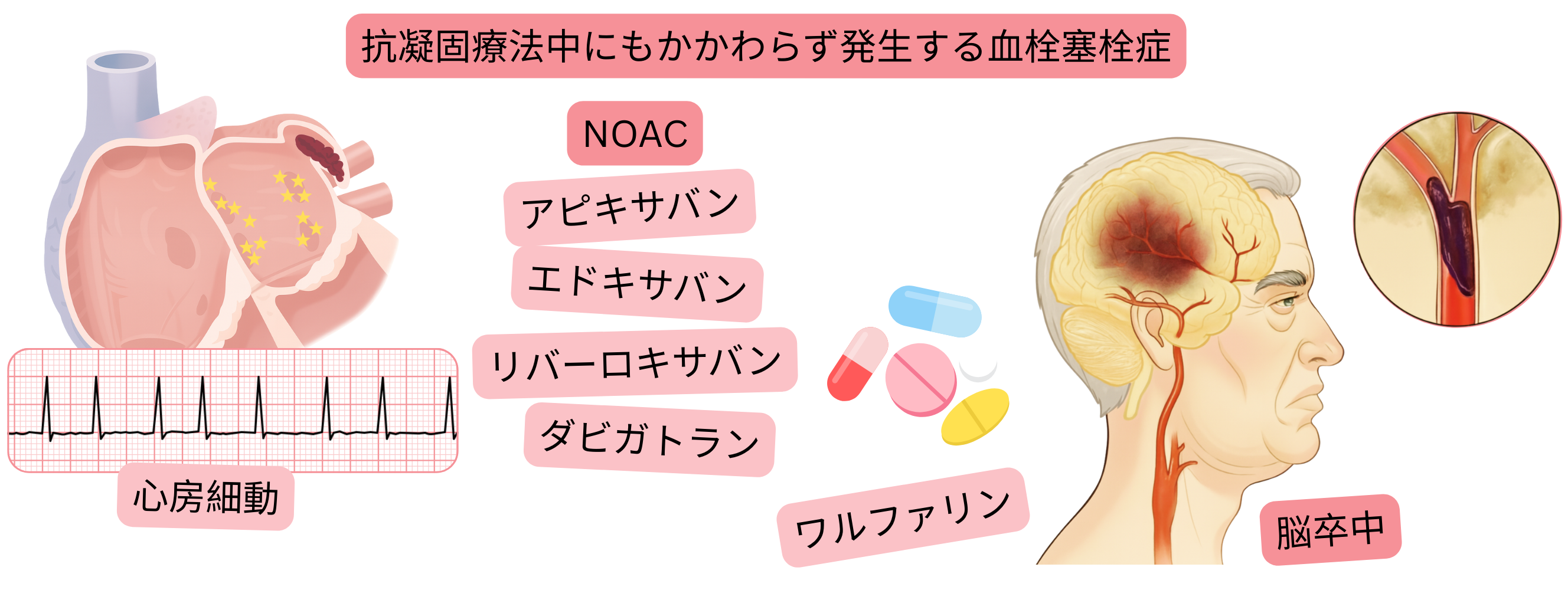 NOACまたはワルファリンによる抗凝固療法にもかかわらず、心房細動患者に血栓塞栓症が発生し、虚血性脳卒中に至ることを示すインフォグラフィック。