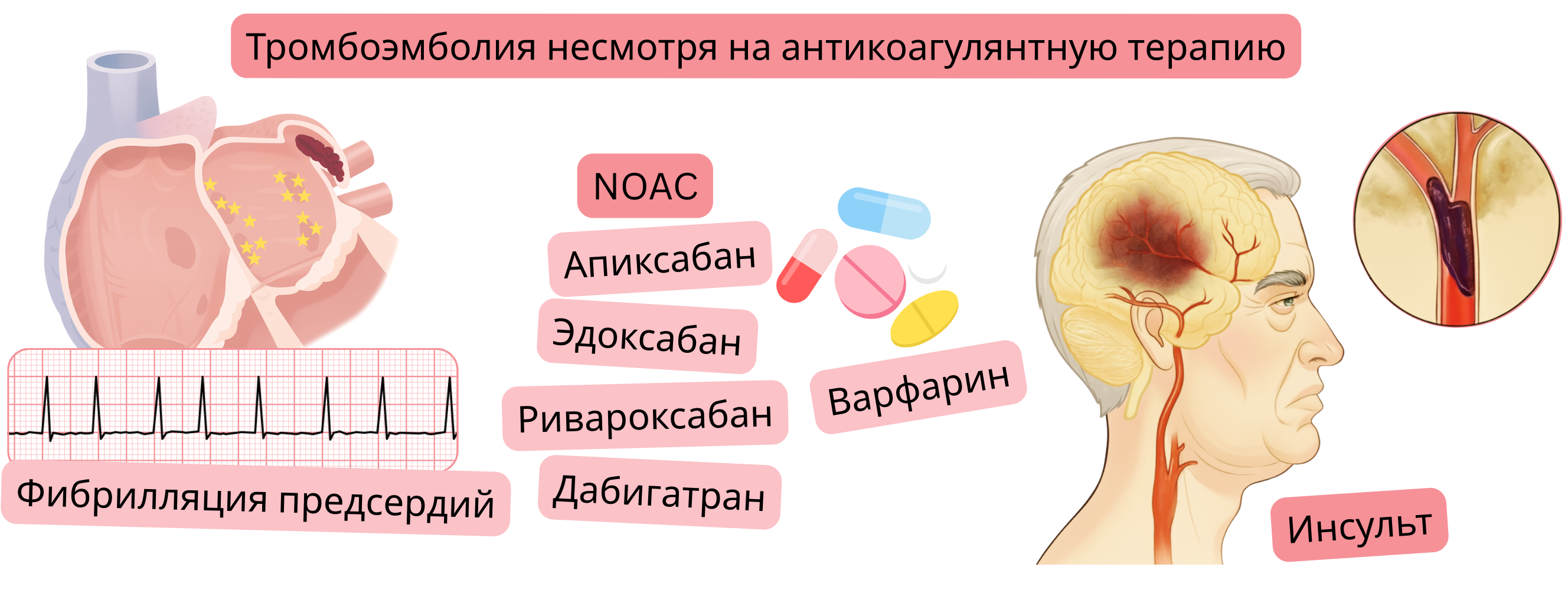 Инфографика, демонстрирующая тромбоэмболию несмотря на антикоагулянтную терапию у пациента с фибрилляцией предсердий, включая лечение ПОАК или варфарином, с развитием ишемического инсульта.