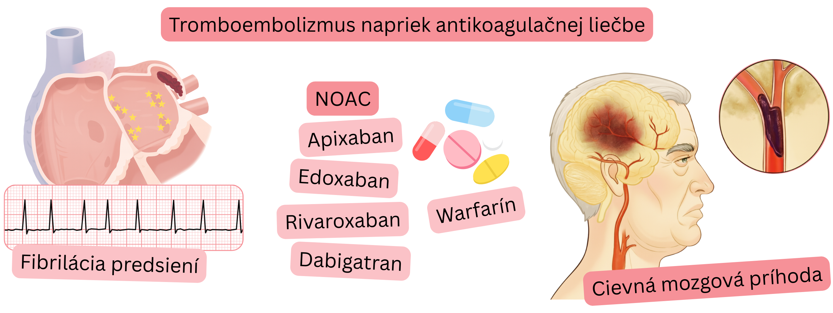 Infografika znázorňujúca tromboembolizmus napriek antikoagulačnej liečbe u pacienta s fibriláciou predsiení vrátane liečby NOAC alebo warfarínom a vzniku ischemickej cievnej mozgovej príhody.