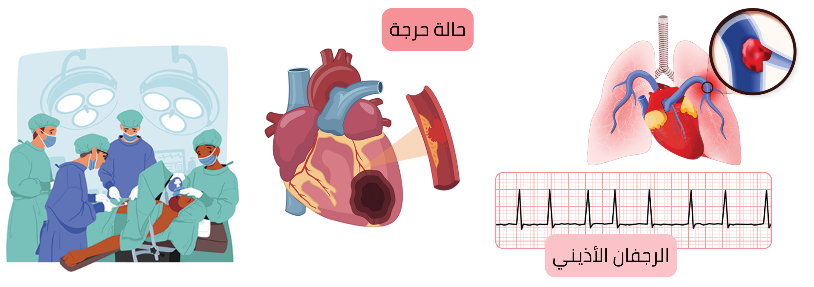 إنفوجرافيك يوضح الحالة الحرجة لمريض مصاب بالرجفان الأذيني، بما في ذلك مضاعفات خثارية صمية شديدة ذات تأثير ديناميكي دموي.