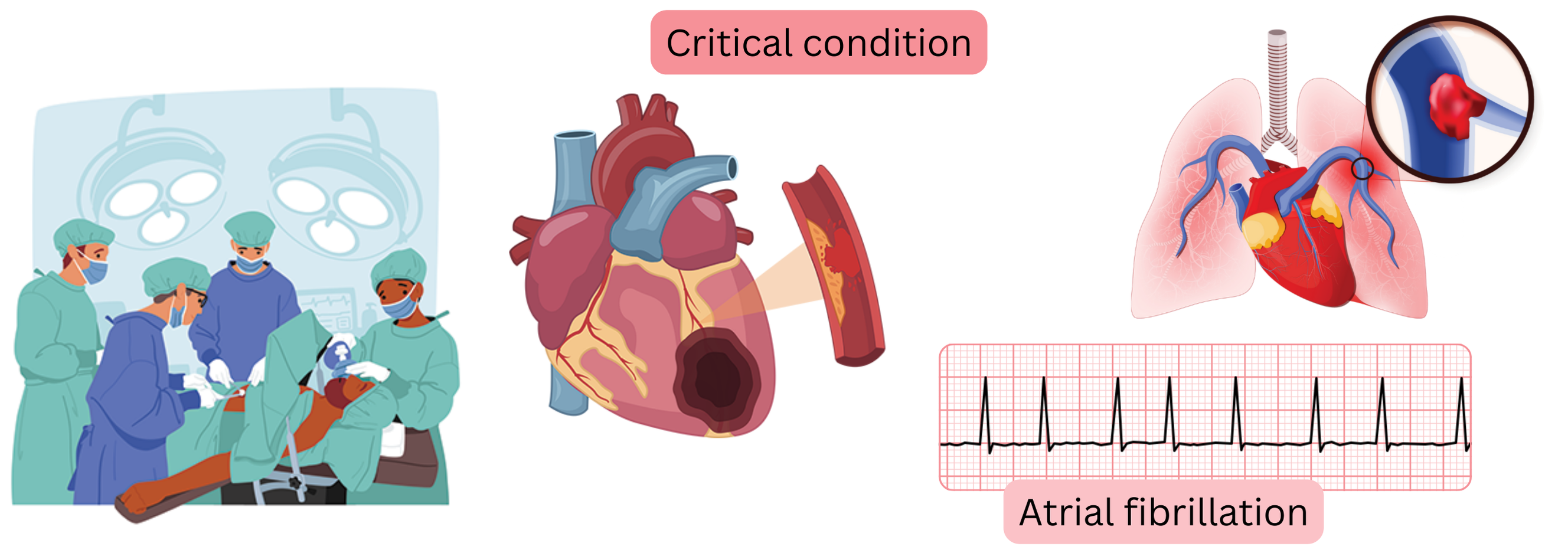 Infographic illustrating a critical condition in a patient with atrial fibrillation, including severe thromboembolic complications with hemodynamic impact.