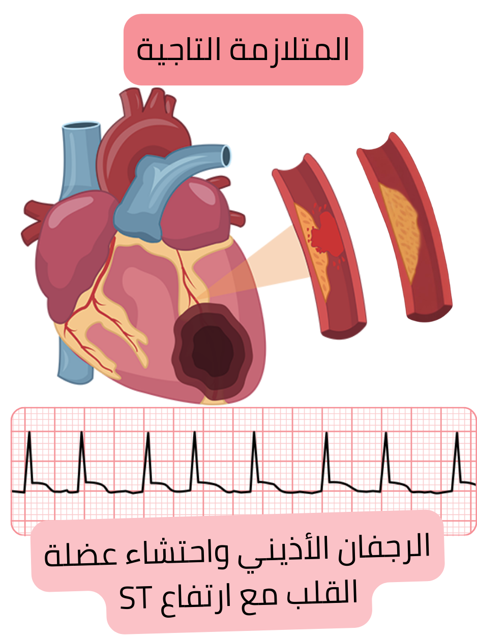 رسم توضيحي لمتلازمة الشريان التاجي الحادة من نوع STEMI مع انسداد تاجي ووجود متزامن للرجفان الأذيني على تخطيط القلب.