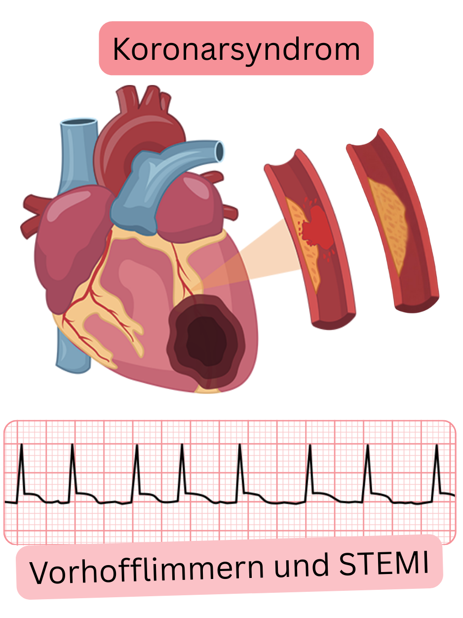 Illustration eines akuten Koronarsyndroms vom Typ STEMI mit Koronarverschluss und gleichzeitigem Auftreten von Vorhofflimmern im EKG.