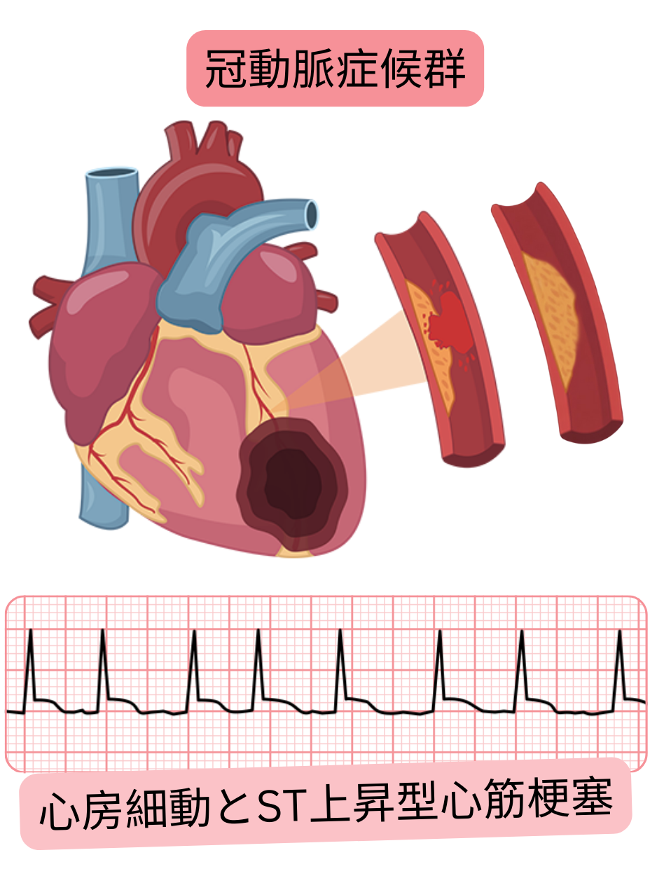 冠動脈閉塞を伴うST上昇型心筋梗塞（STEMI）と、心電図上に同時に認められる心房細動を示すイラスト。