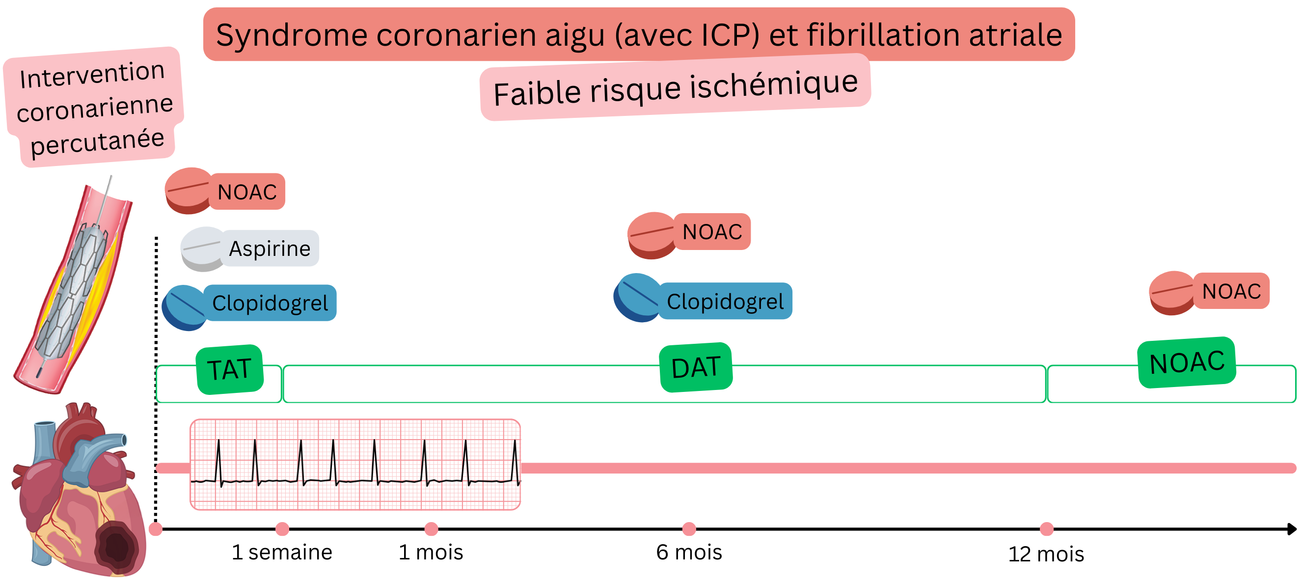 Infographie illustrant la stratégie de traitement antithrombotique chez les patients atteints de syndrome coronarien aigu après ICP et fibrillation atriale à faible risque ischémique, avec un passage progressif de la TAT à la DAT puis à une monothérapie par AOD.