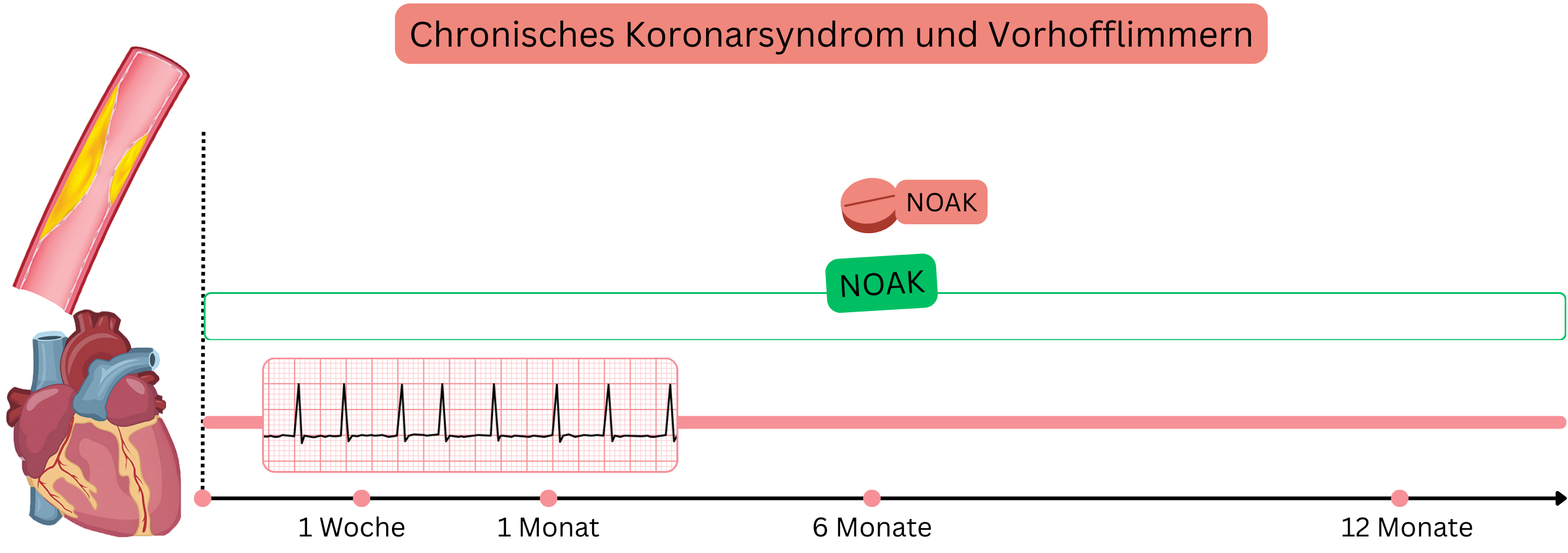 Infografik zur Darstellung der Behandlung von Vorhofflimmern beim chronischen Koronarsyndrom ohne kürzliche PCI mit langfristiger NOAK-Monotherapie.